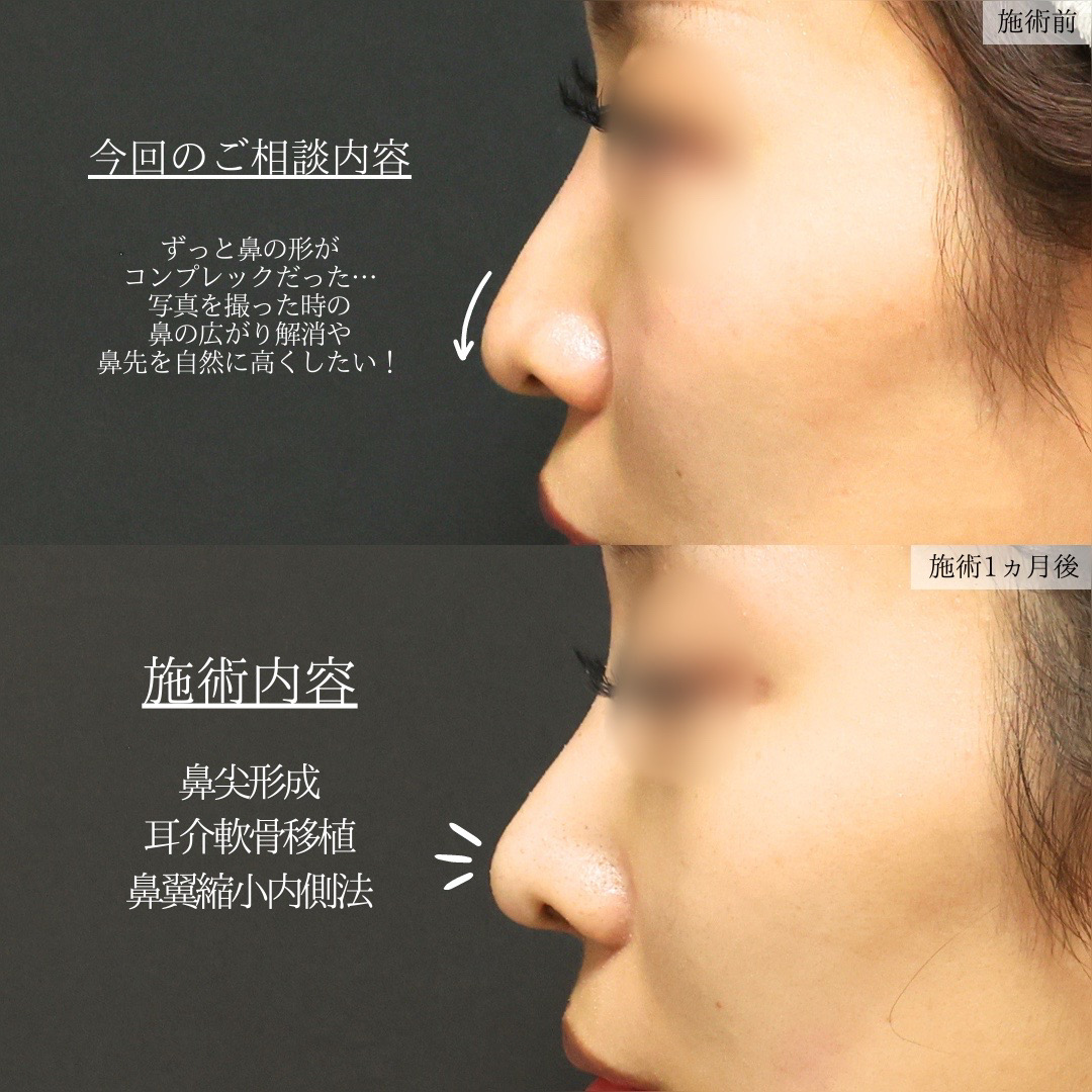 鼻尖形成・鼻尖縮小/鼻先軟骨移植/TAC式 鼻翼縮小術(小鼻縮小)の症例写真 施術前後