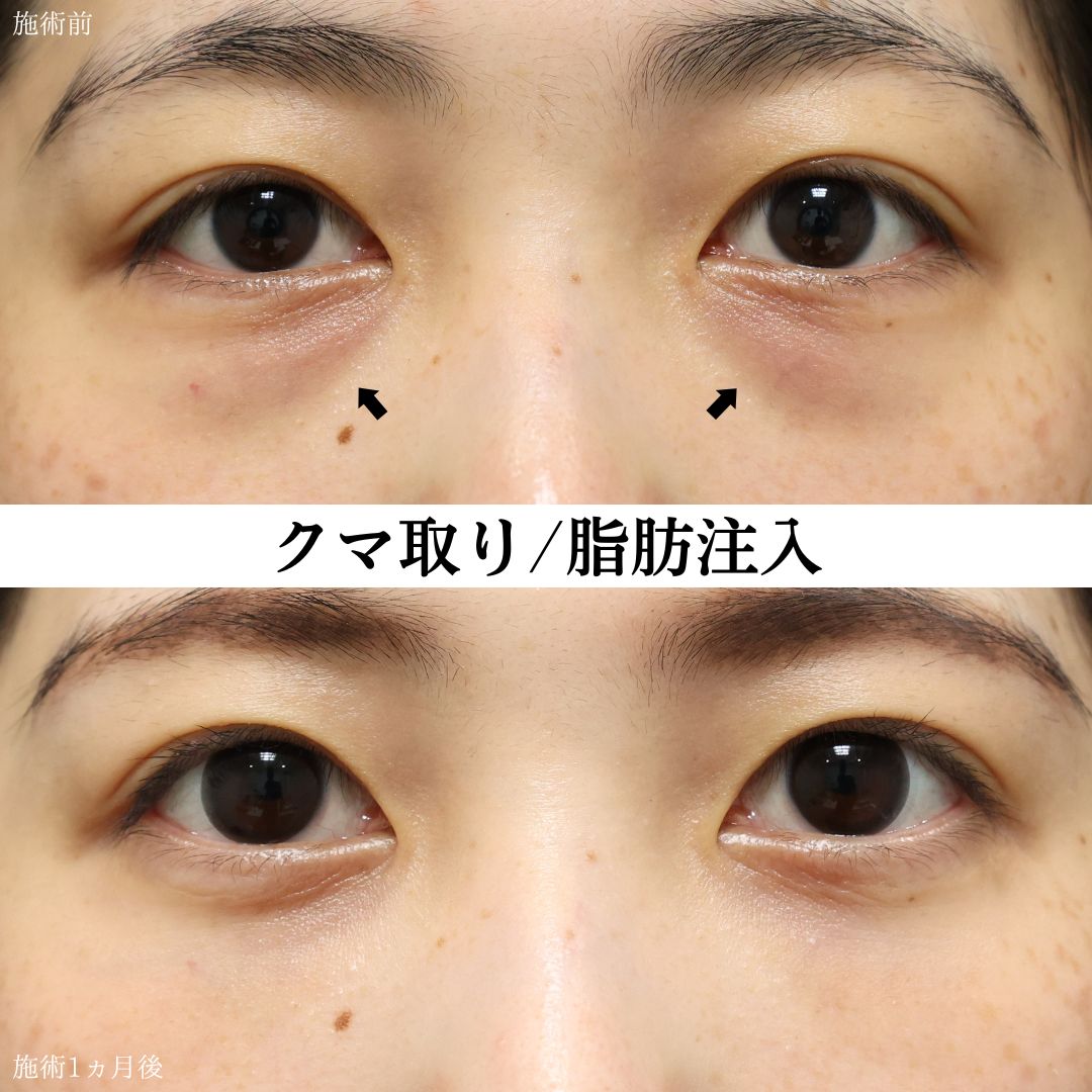 下眼瞼脱脂術(目の下のたるみ取り・目の下の脂肪ふくらみ取り)の症例写真 施術前後