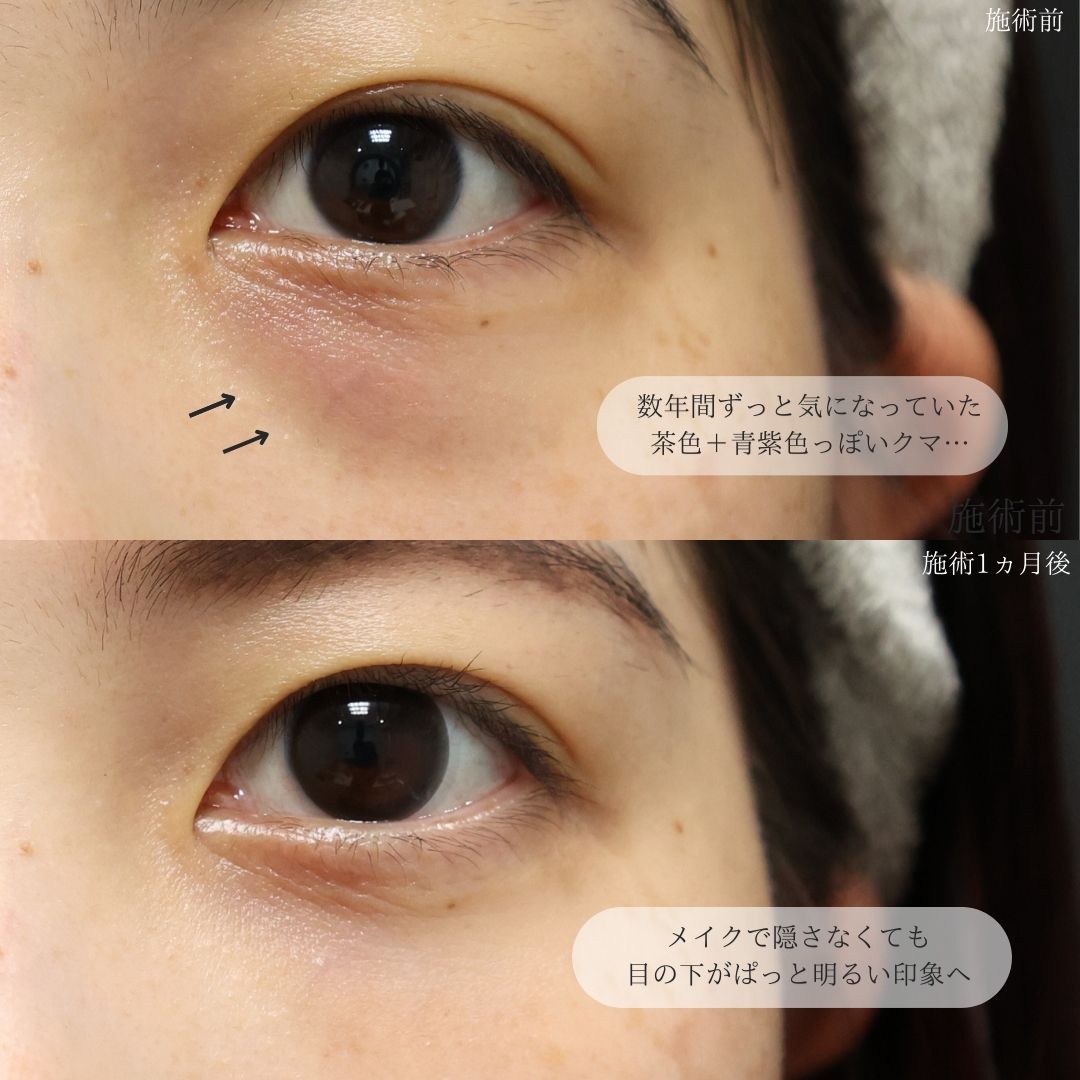 下眼瞼脱脂術(目の下のたるみ取り・目の下の脂肪ふくらみ取り)の症例写真 施術前後