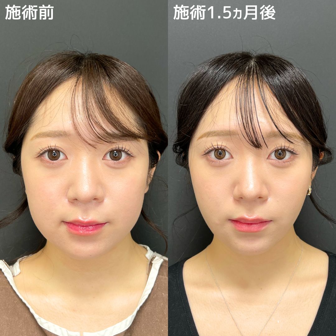 《小顔施術》でご予定前にメンテナス