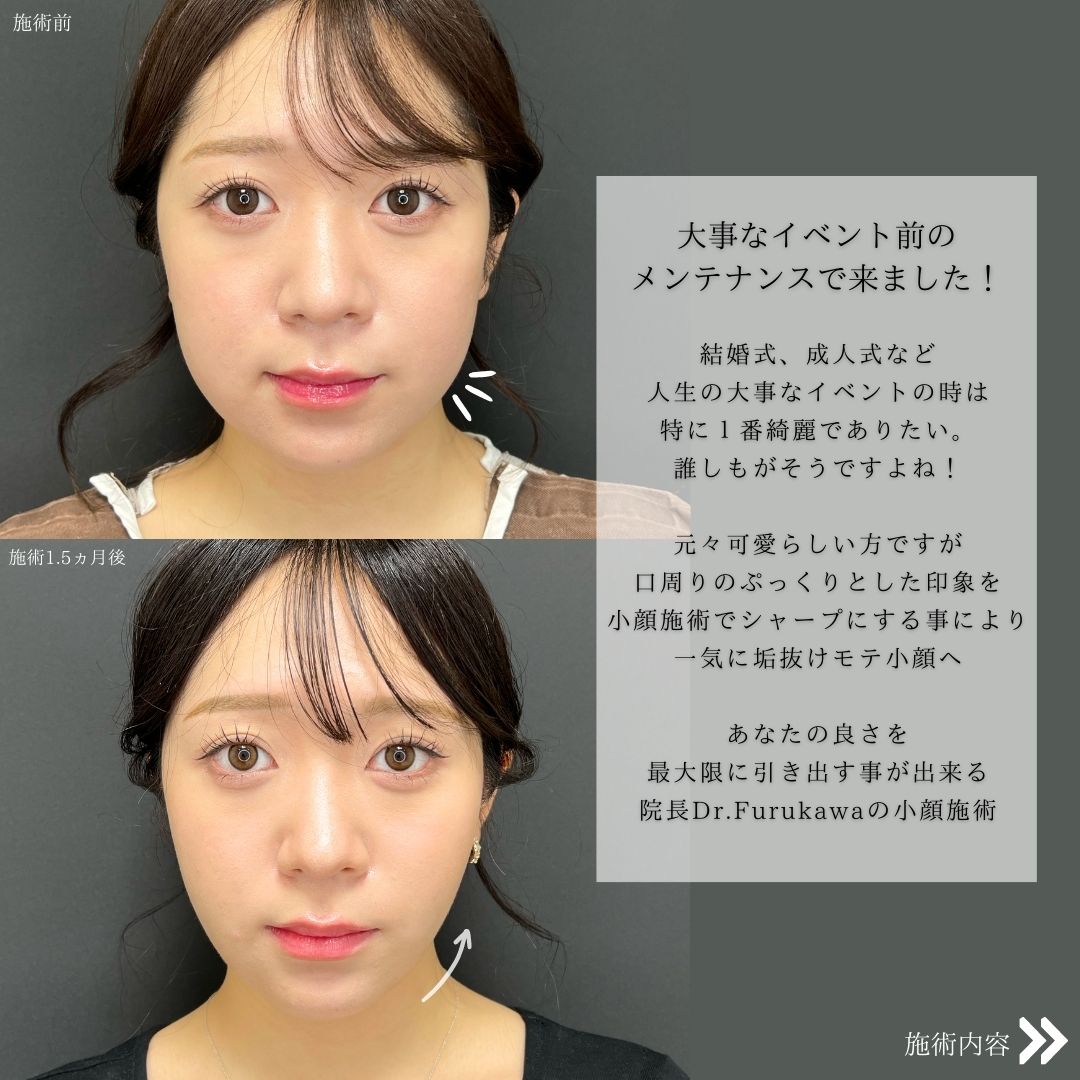 TAC式 ツヤ肌コラーゲンリフト®/ジョールファット除去/バッカルファット除去の症例写真 施術前後 