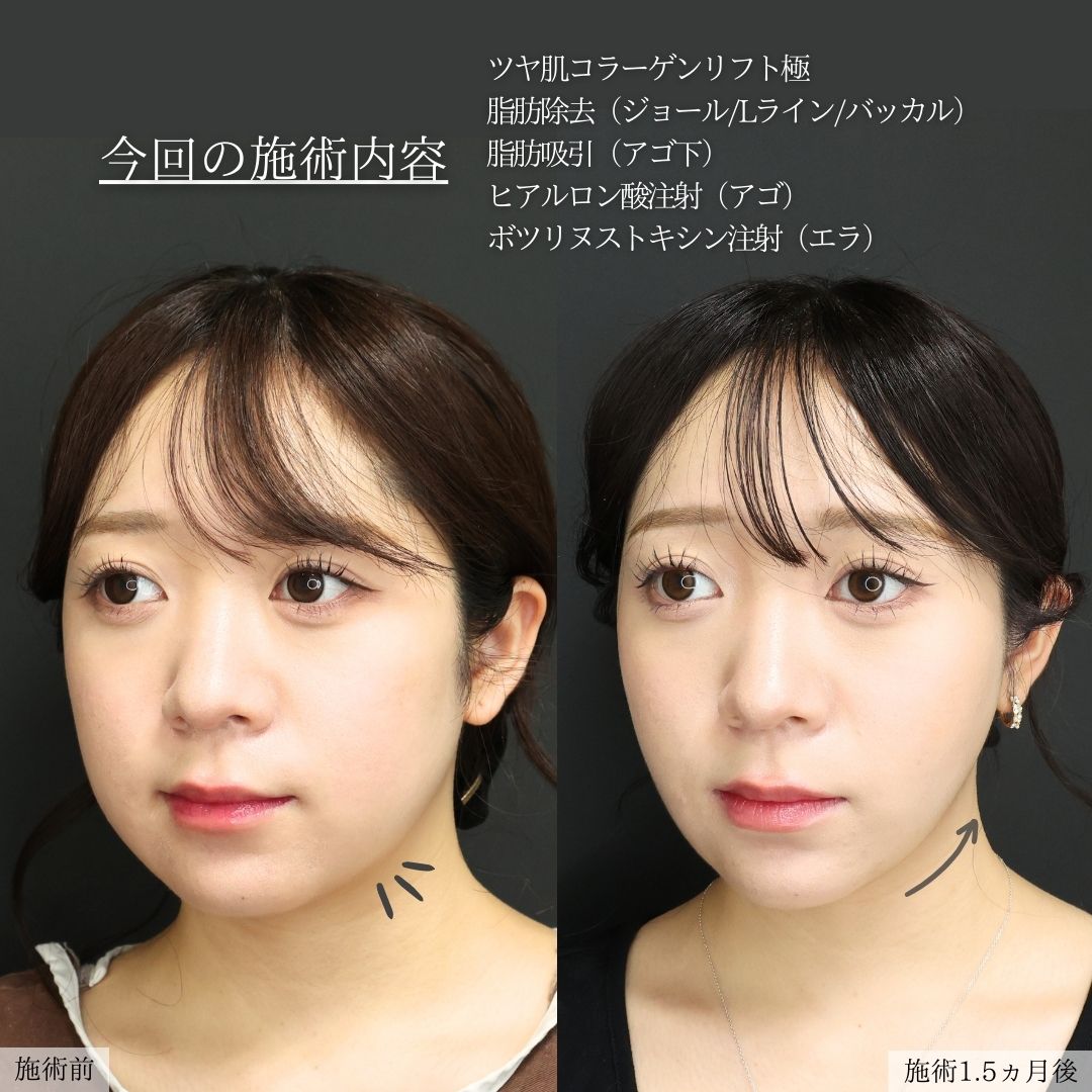 TAC式 ツヤ肌コラーゲンリフト®/ジョールファット除去/バッカルファット除去の症例写真 施術前後 