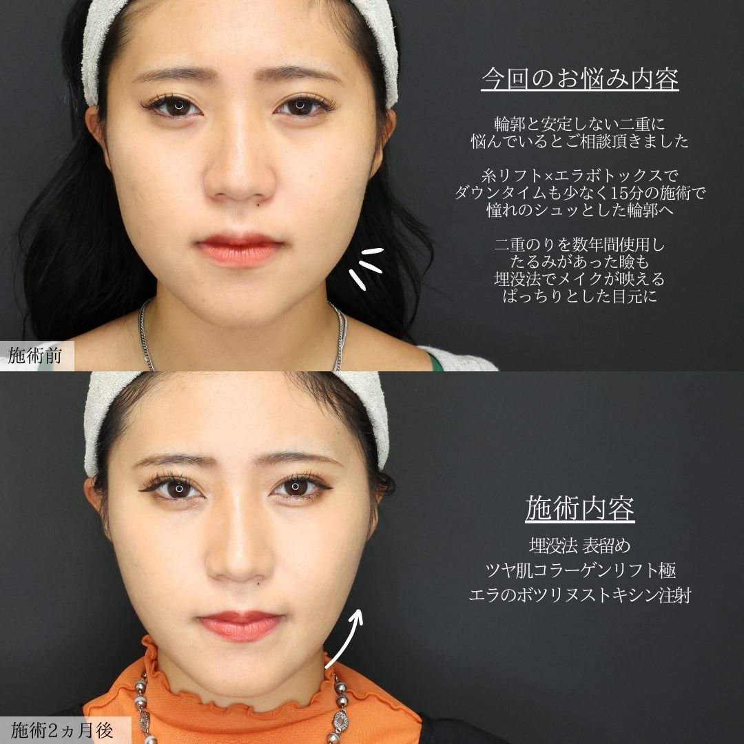 TAC式 ツヤ肌コラーゲンリフト®/エラボトックス注射/二重埋没法の症例写真 施術前後 