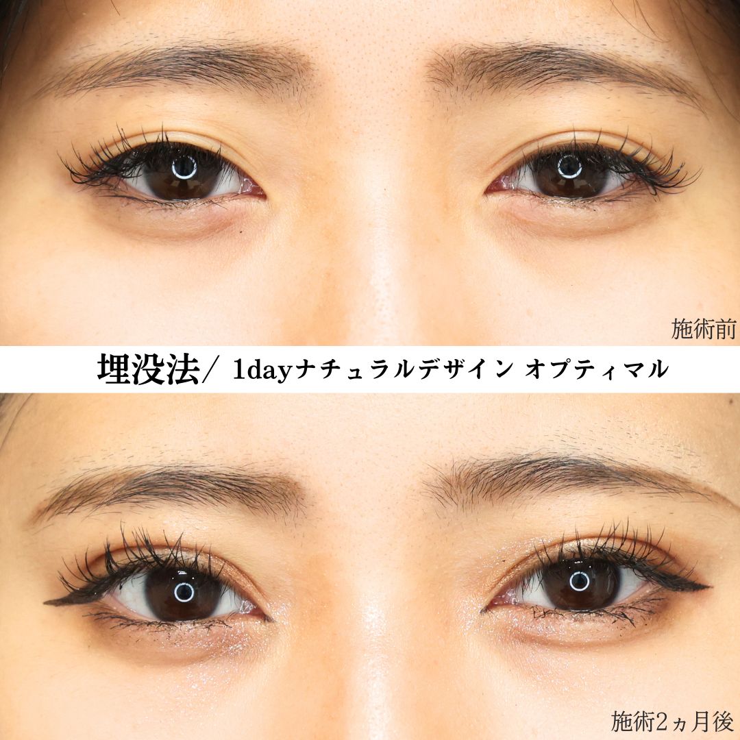 TAC式 ツヤ肌コラーゲンリフト®/エラボトックス注射/二重埋没法の症例写真 施術前後 