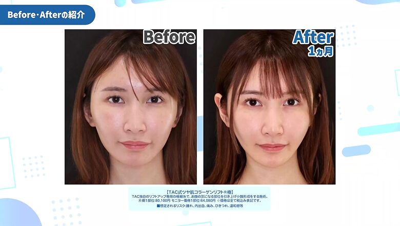 ツヤ肌コラーゲンリフト極を受けた天川そらさんの正面ビフォーアフター症例写真