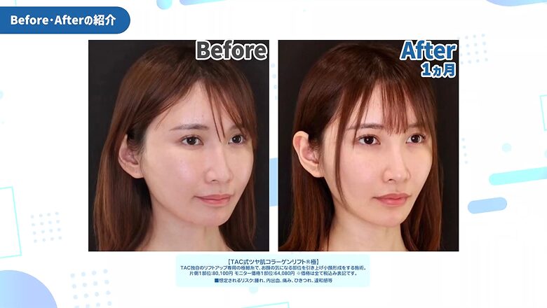 ツヤ肌コラーゲンリフト極を受けた天川そらさんの斜め45度ビフォーアフター症例写真