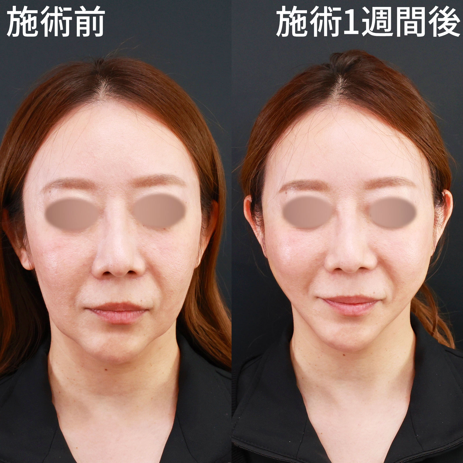 【糸リフト】極の糸で強力リフトアップ！アプリ級のVライン形成！