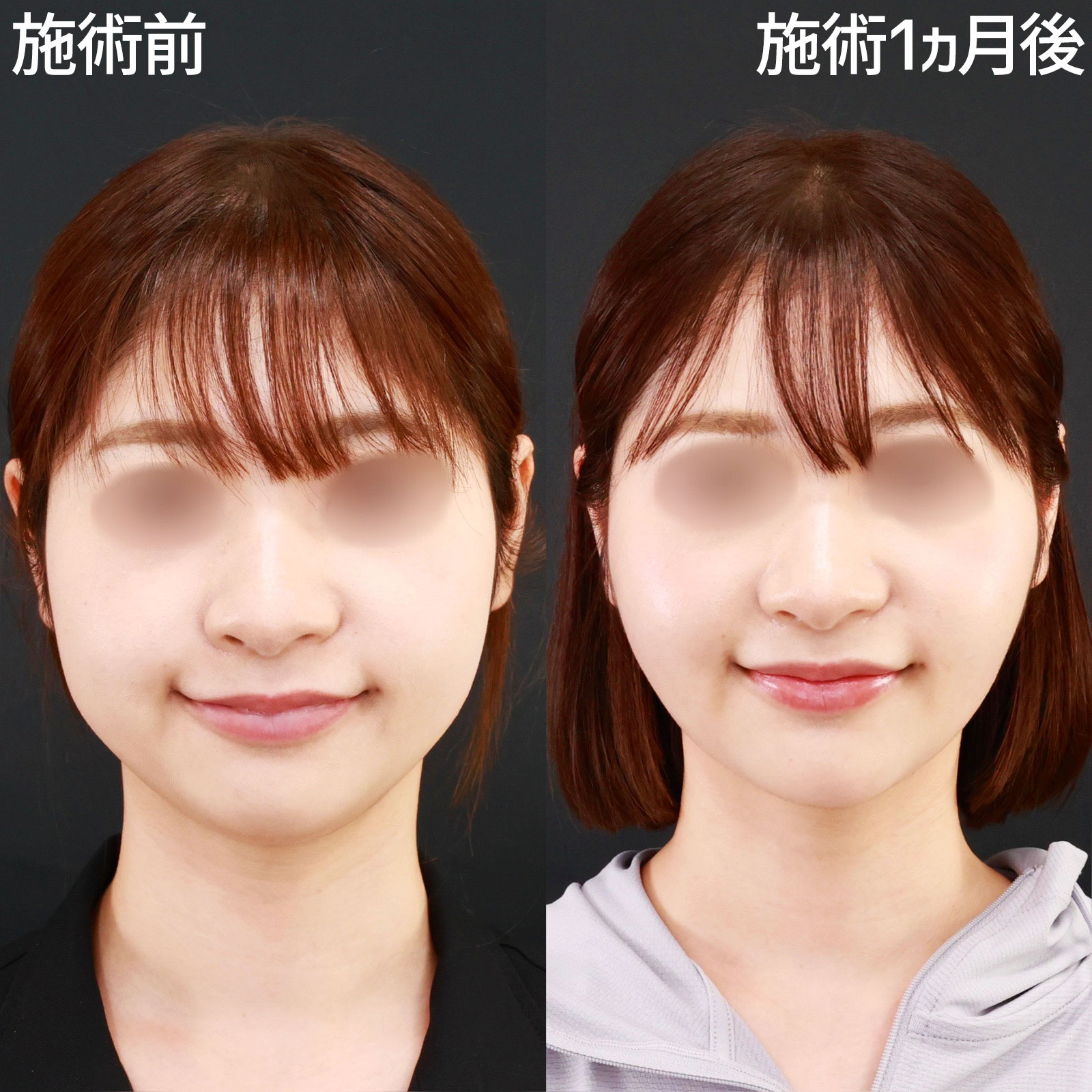 【バッカルファット除去】脂肪除去と糸リフト極で、笑顔もより美しく！