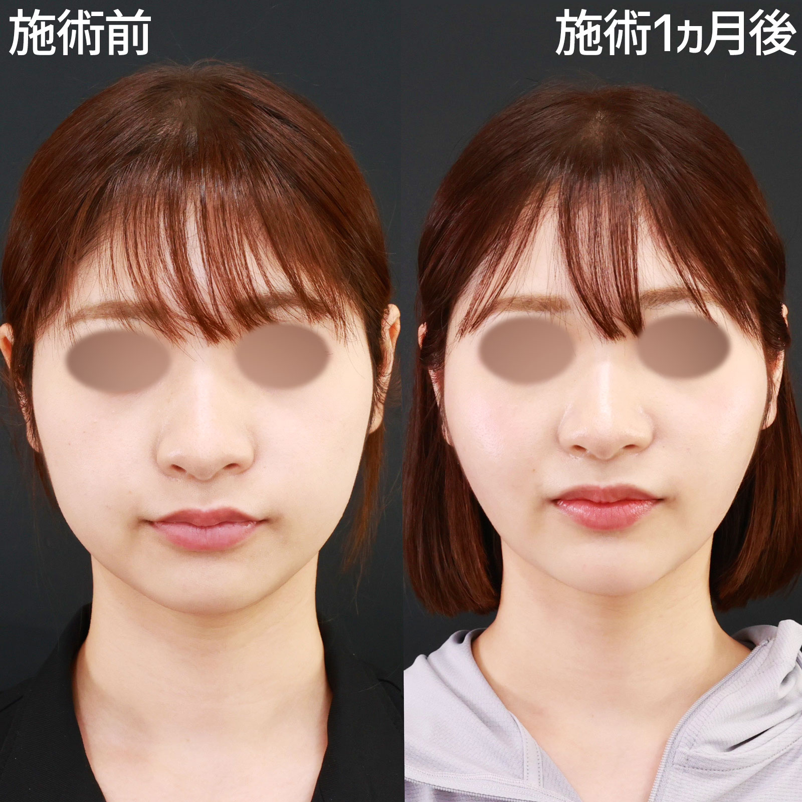 バッカルファット除去/TAC式 ツヤ肌コラーゲンリフト®/顎のヒアルロン酸注射の症例写真 施術前後 