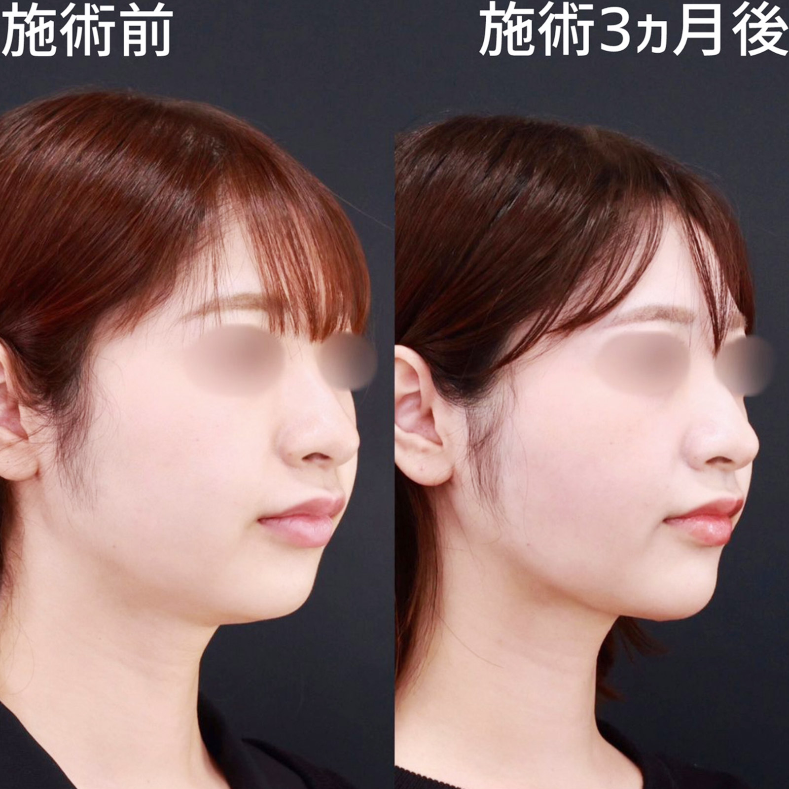 バッカルファット除去/TAC式 ツヤ肌コラーゲンリフト®/顎のヒアルロン酸注射の症例写真 施術前後 