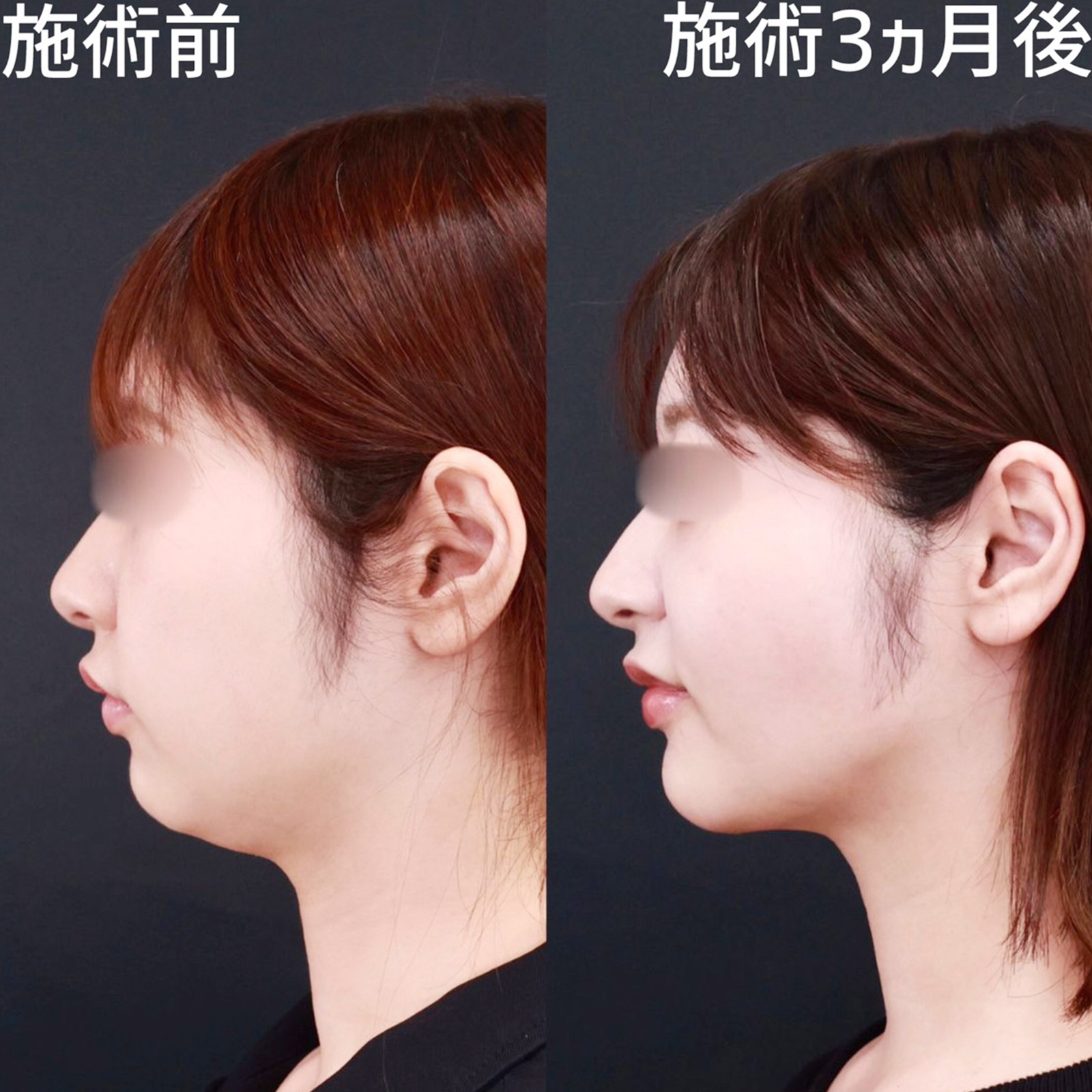 バッカルファット除去/TAC式 ツヤ肌コラーゲンリフト®/顎のヒアルロン酸注射の症例写真 施術前後 