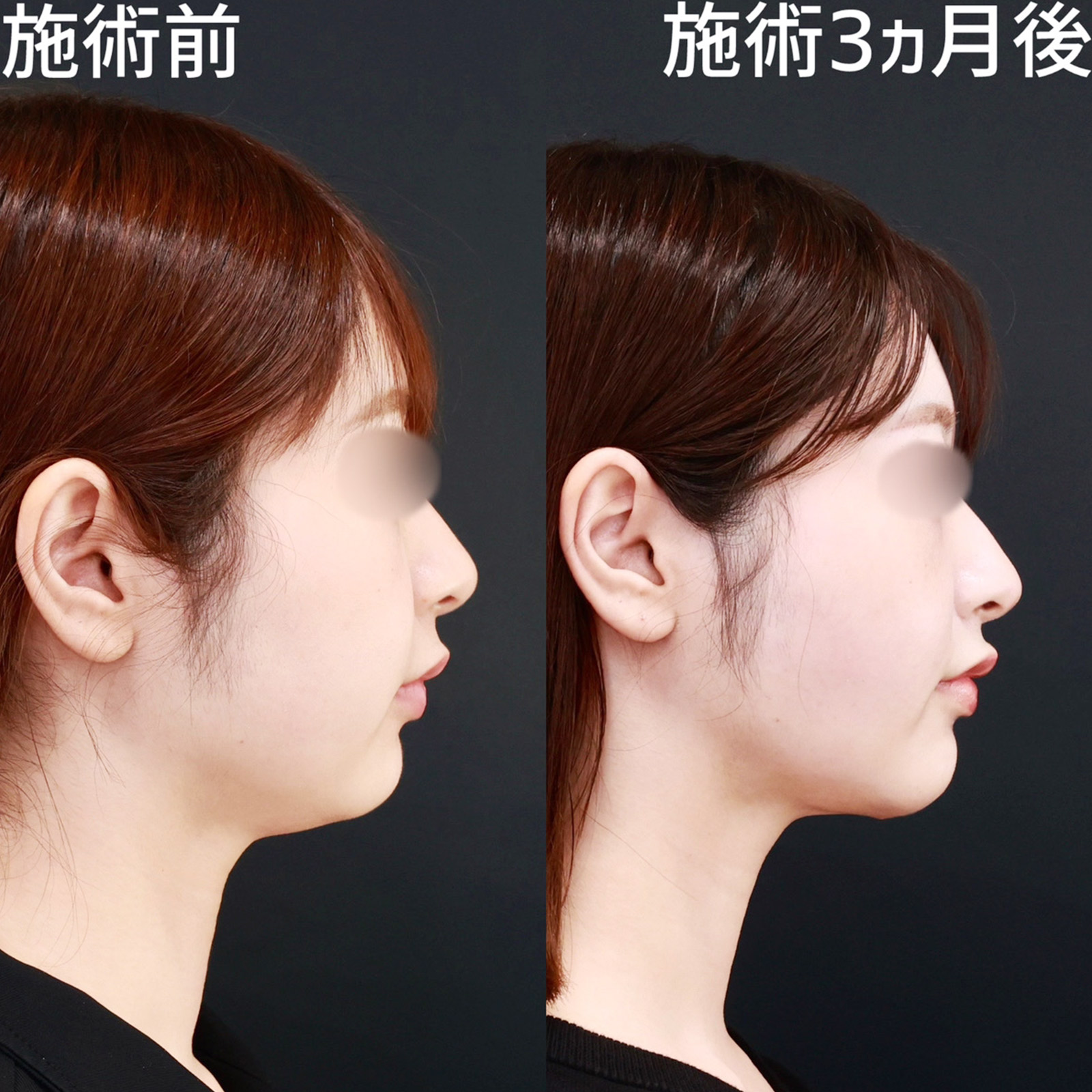 バッカルファット除去/TAC式 ツヤ肌コラーゲンリフト®/顎のヒアルロン酸注射の症例写真 施術前後 