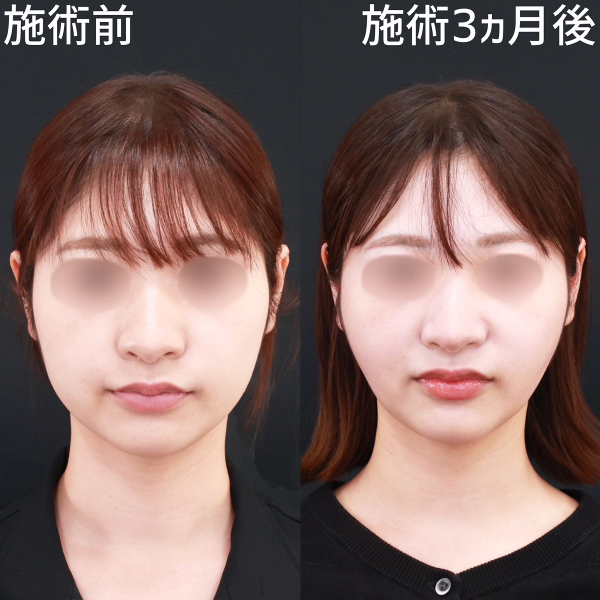 バッカルファット除去/TAC式 ツヤ肌コラーゲンリフト®/顎のヒアルロン酸注射の症例写真 施術前後 