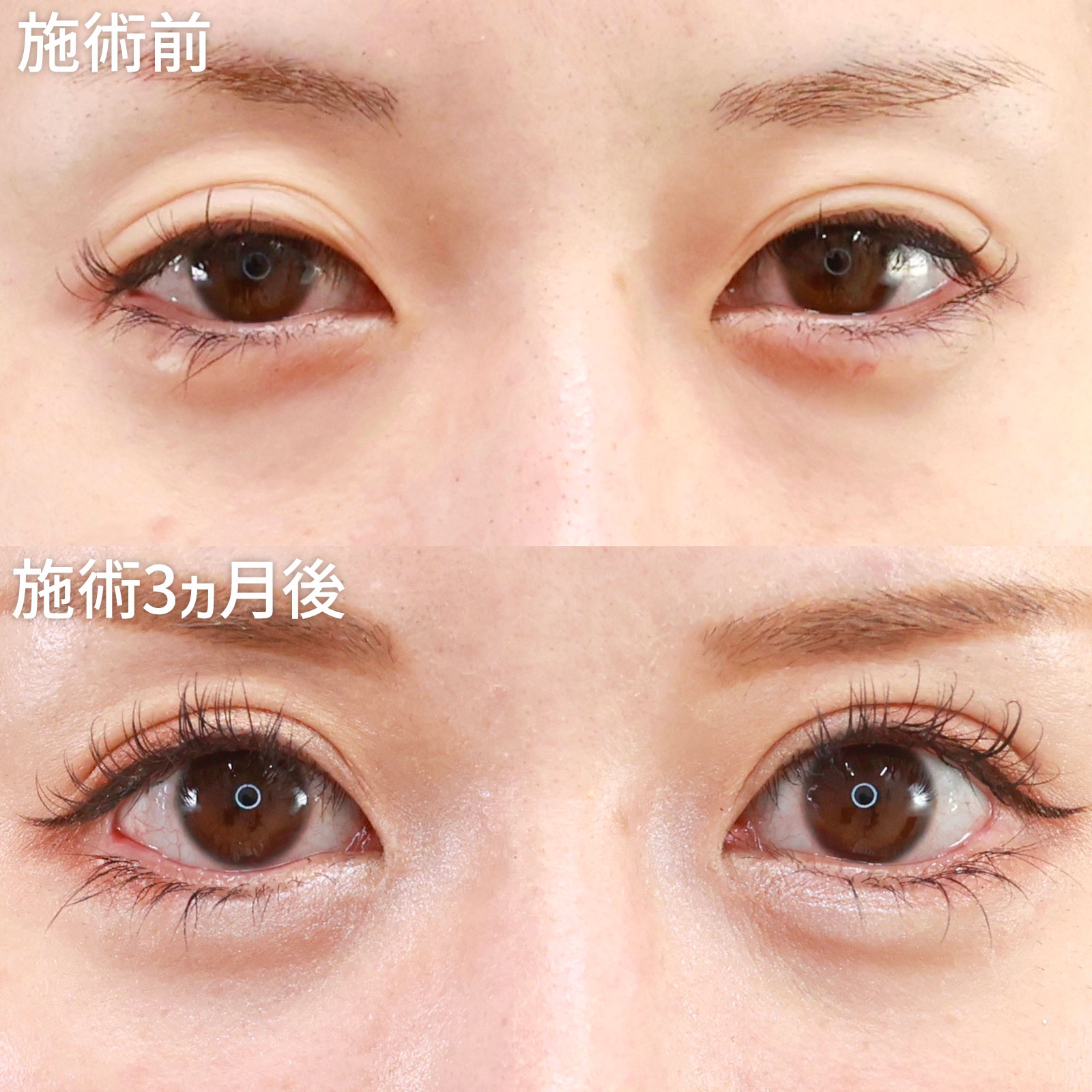 【二重全切開＆グラマラスライン】バランス良く、自然に目元を大きく見せる！