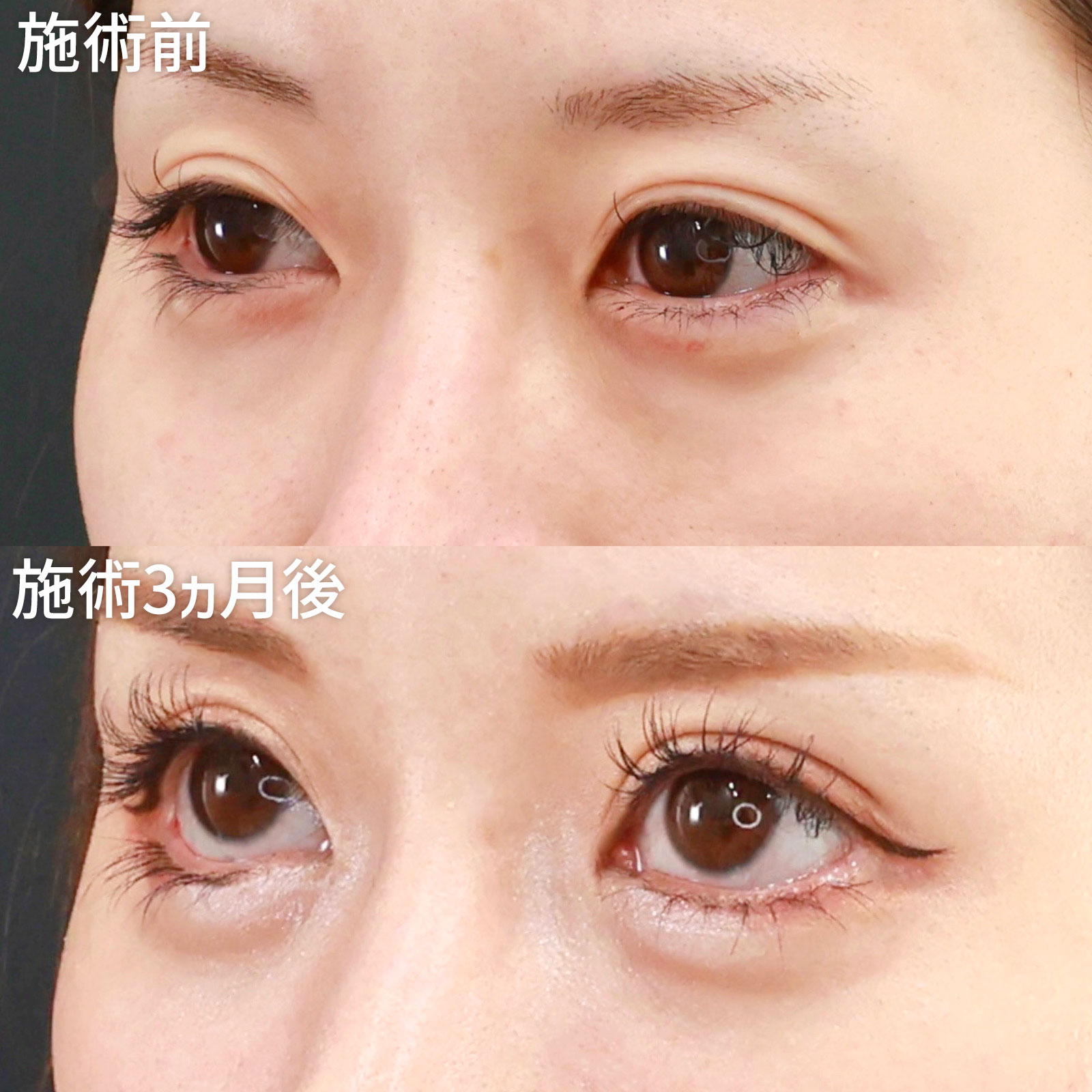 二重切開（全切開法）/眼瞼下垂（目つき矯正）/グラマラスライン（タレ目形成）の症例写真 施術前後 