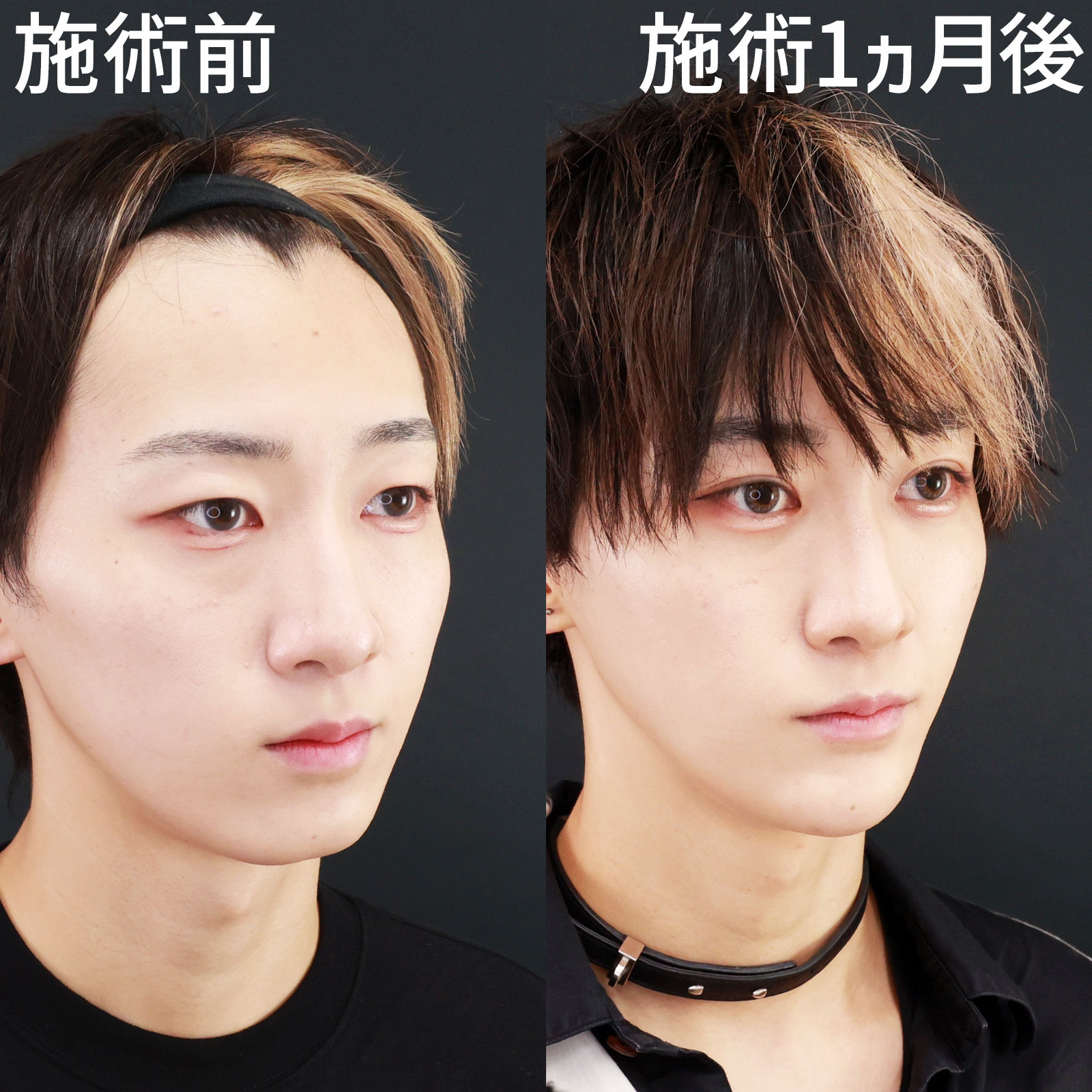 TAC式 ツヤ肌コラーゲンリフト®/顎のヒアルロン酸注射の症例写真 施術前後