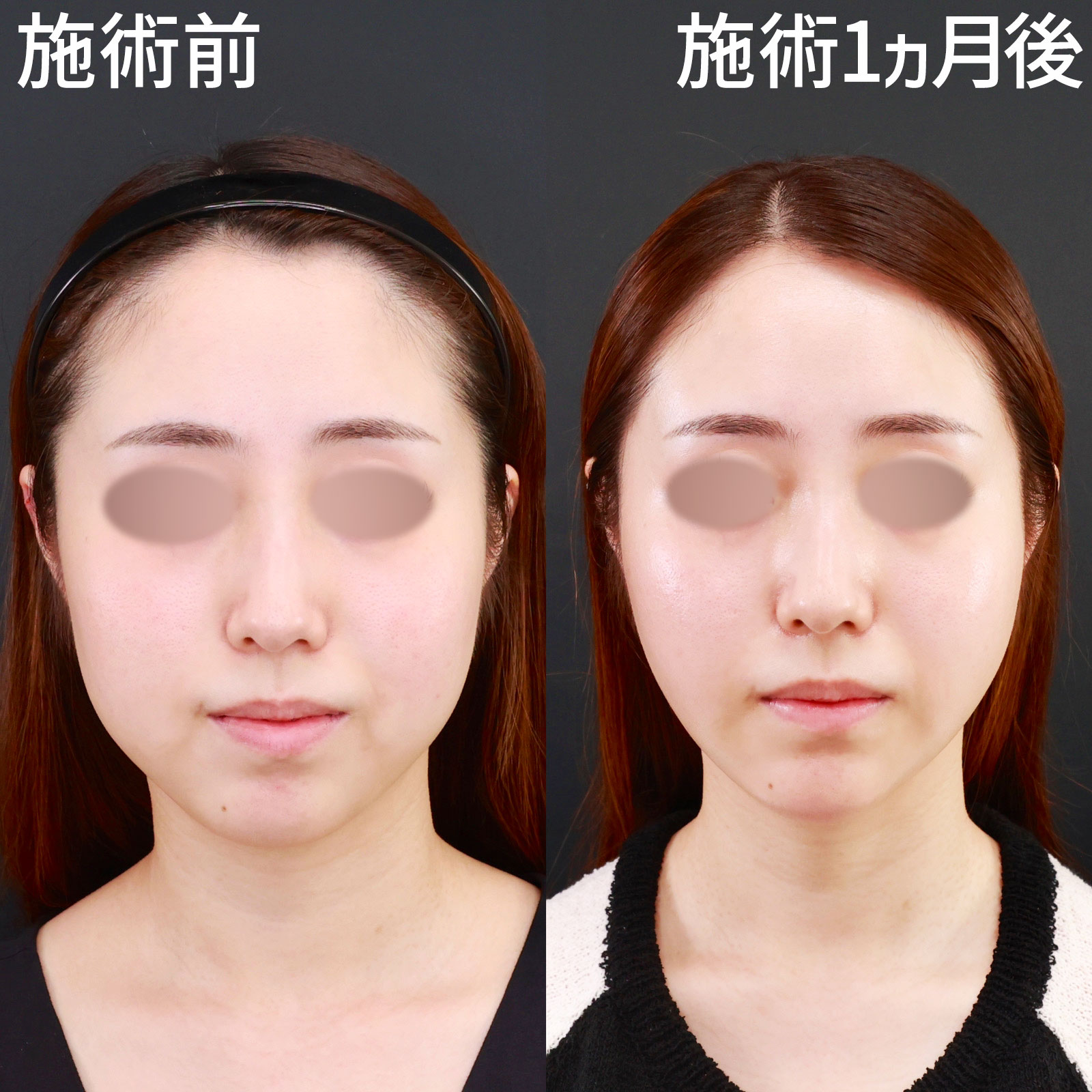 【顔の脂肪吸引】余分な脂肪を除去して、圧倒的に顔を小さく！