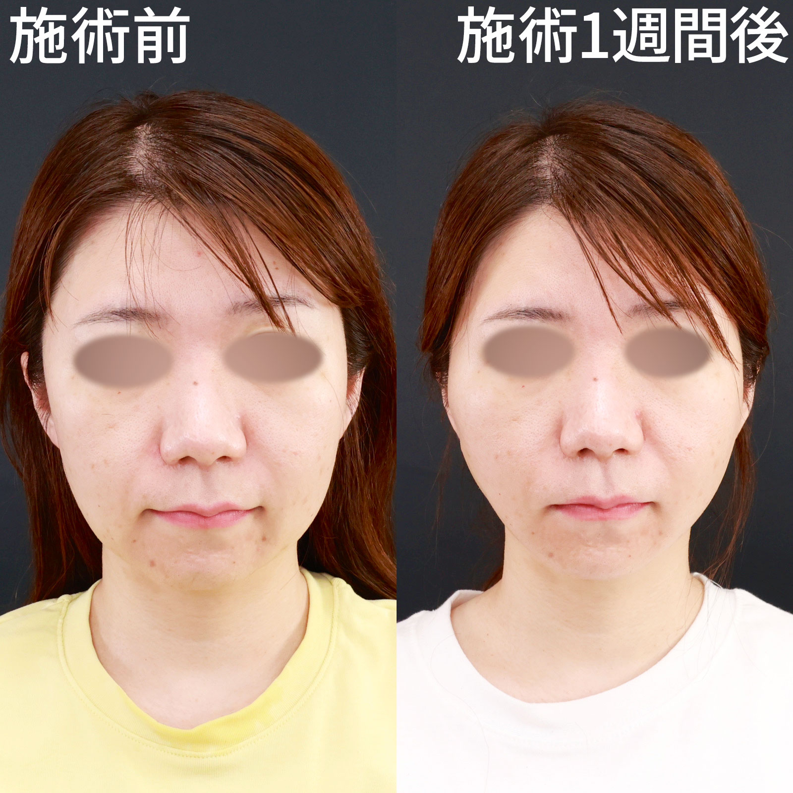 TAC式 ツヤ肌コラーゲンリフト®の症例写真 施術前後