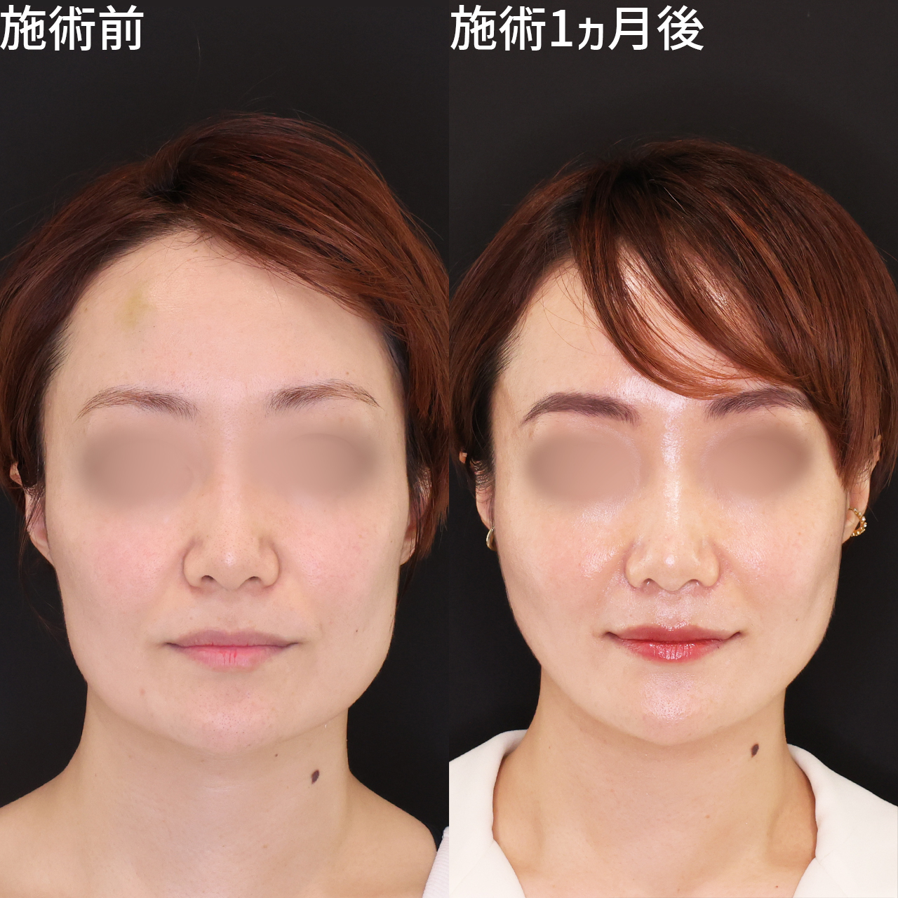 脂肪除去なし！気軽な施術で輪郭劇的改善