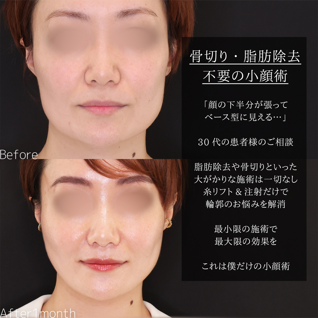 TAC式 ツヤ肌コラーゲンリフト®/エラボトックス注射/ヒアルロン酸注射：その他の症例写真 施術前後 