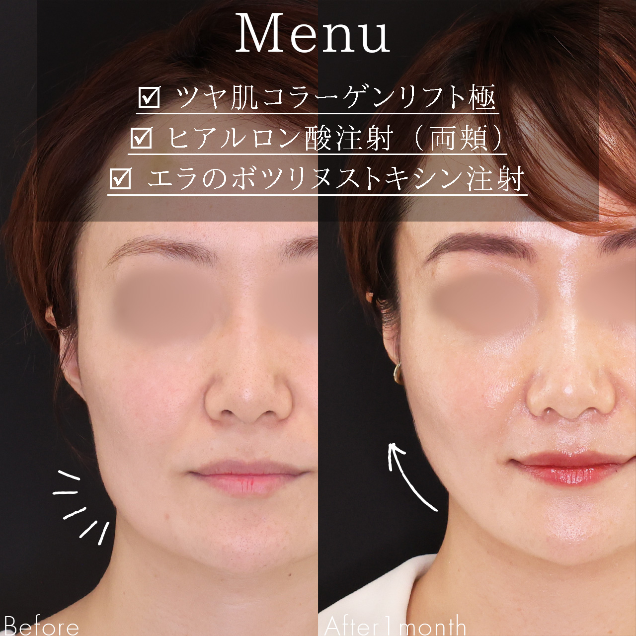 TAC式 ツヤ肌コラーゲンリフト®/エラボトックス注射/ヒアルロン酸注射：その他の症例写真 施術前後 