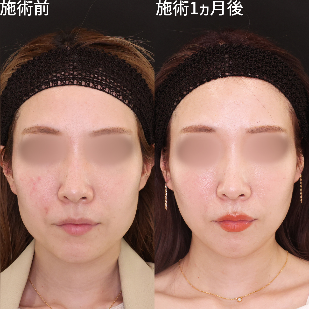 頬骨下の窪みを改善。個々人のお顔に合わせたオーダーメイドの小顔術