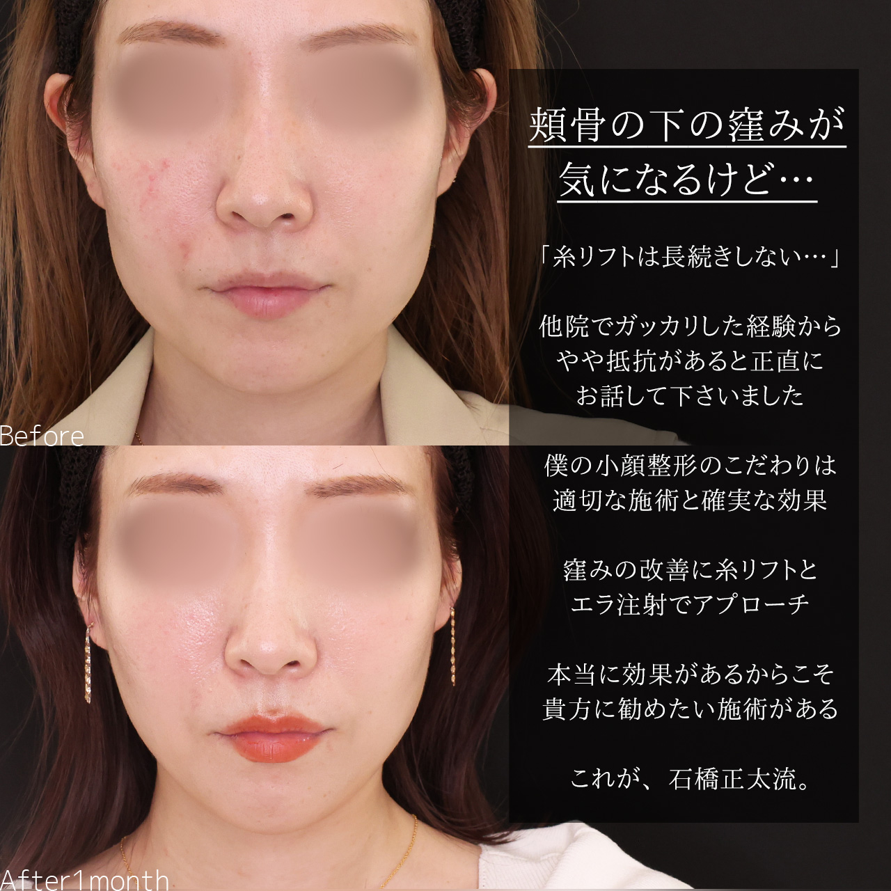 TAC式 ツヤ肌コラーゲンリフト®/エラボトックス注射の症例写真 施術前後 