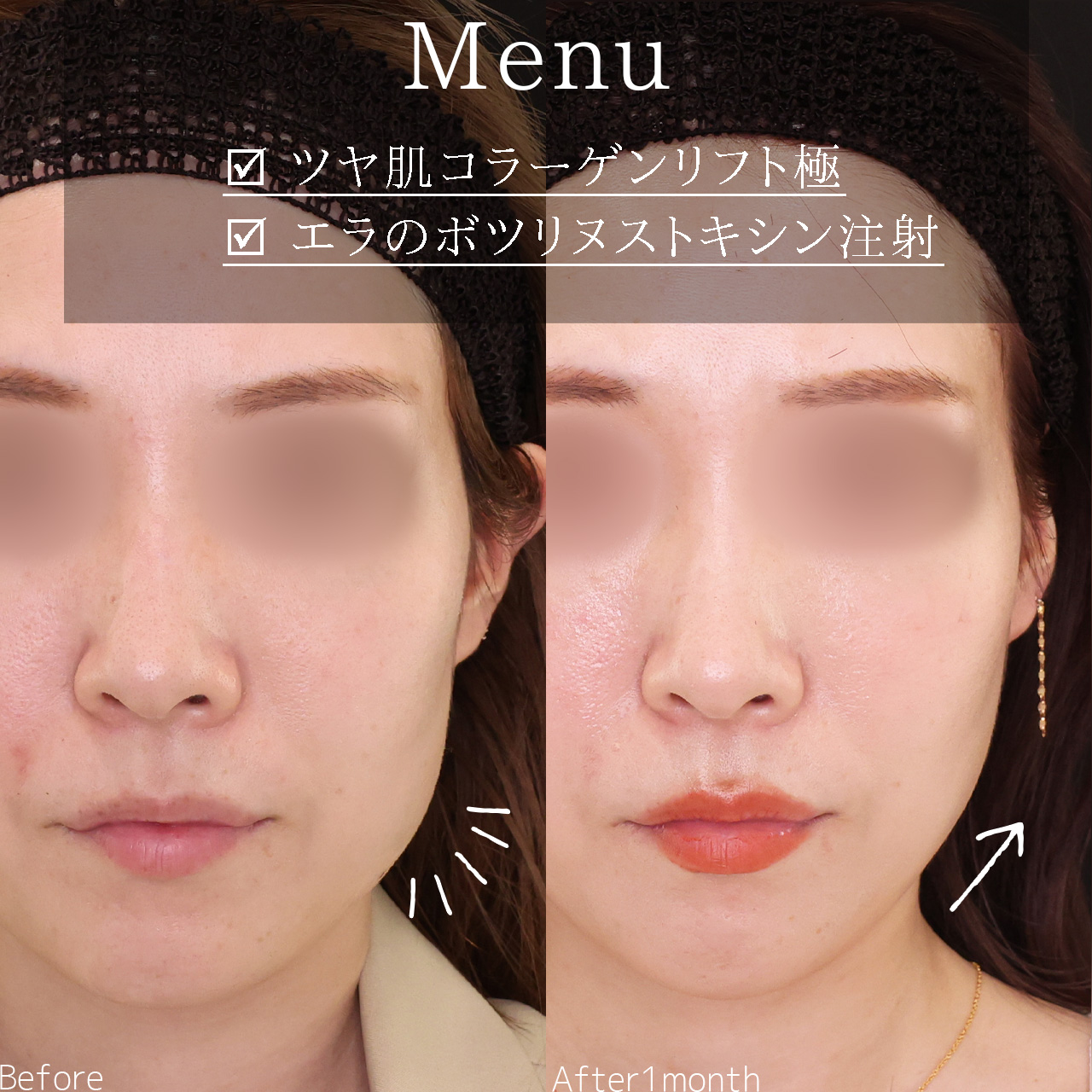 TAC式 ツヤ肌コラーゲンリフト®/エラボトックス注射の症例写真 施術前後 