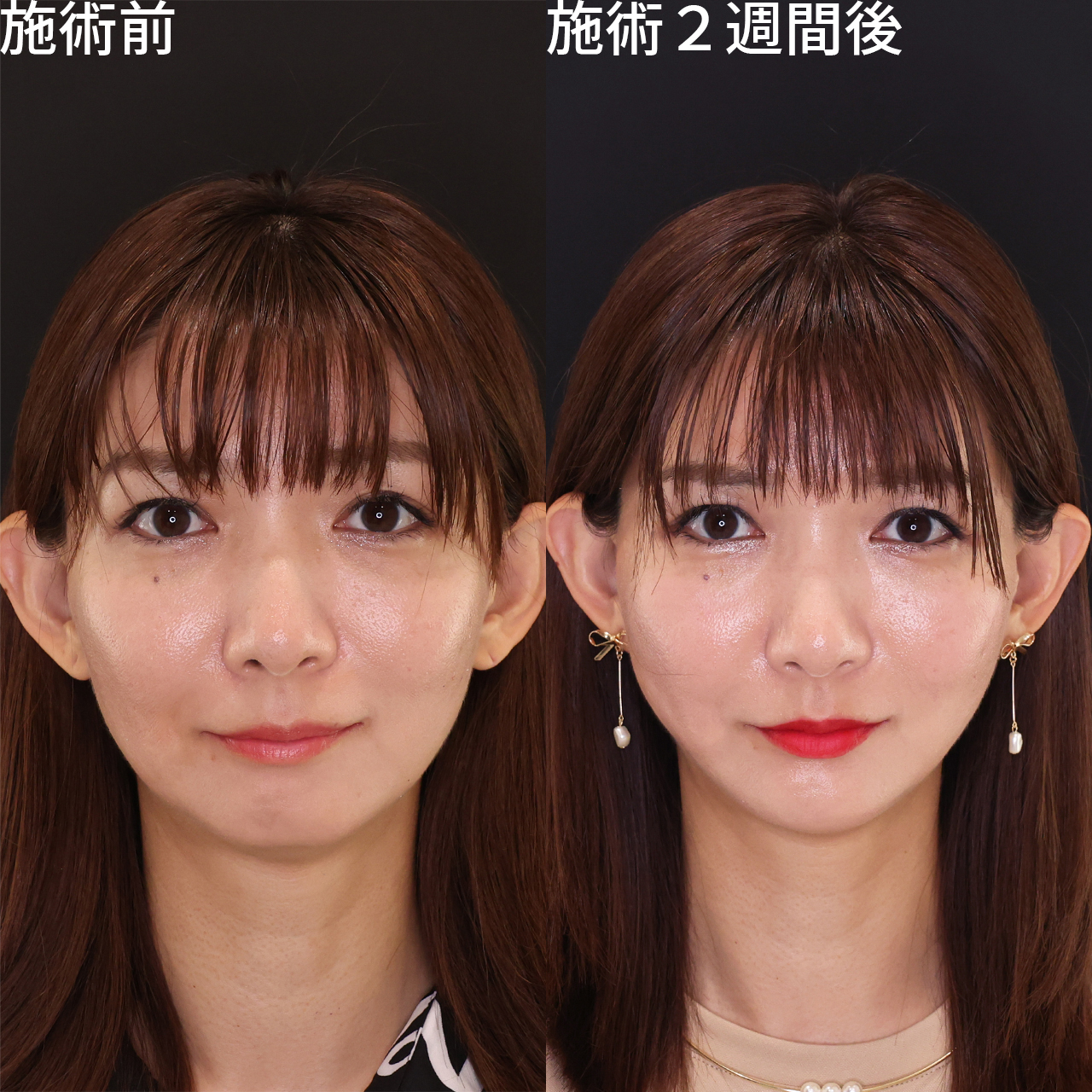 TAC式 ツヤ肌コラーゲンリフト®/顎のヒアルロン酸注射の症例写真 施術前後 