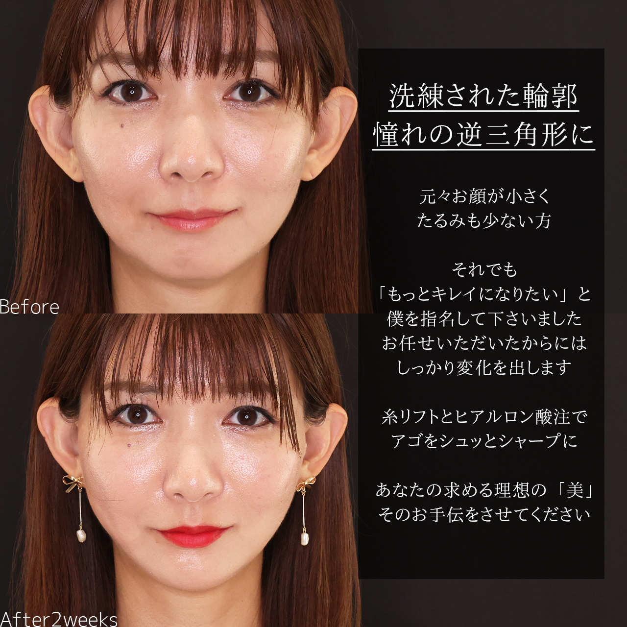 TAC式 ツヤ肌コラーゲンリフト®/顎のヒアルロン酸注射の症例写真 施術前後 