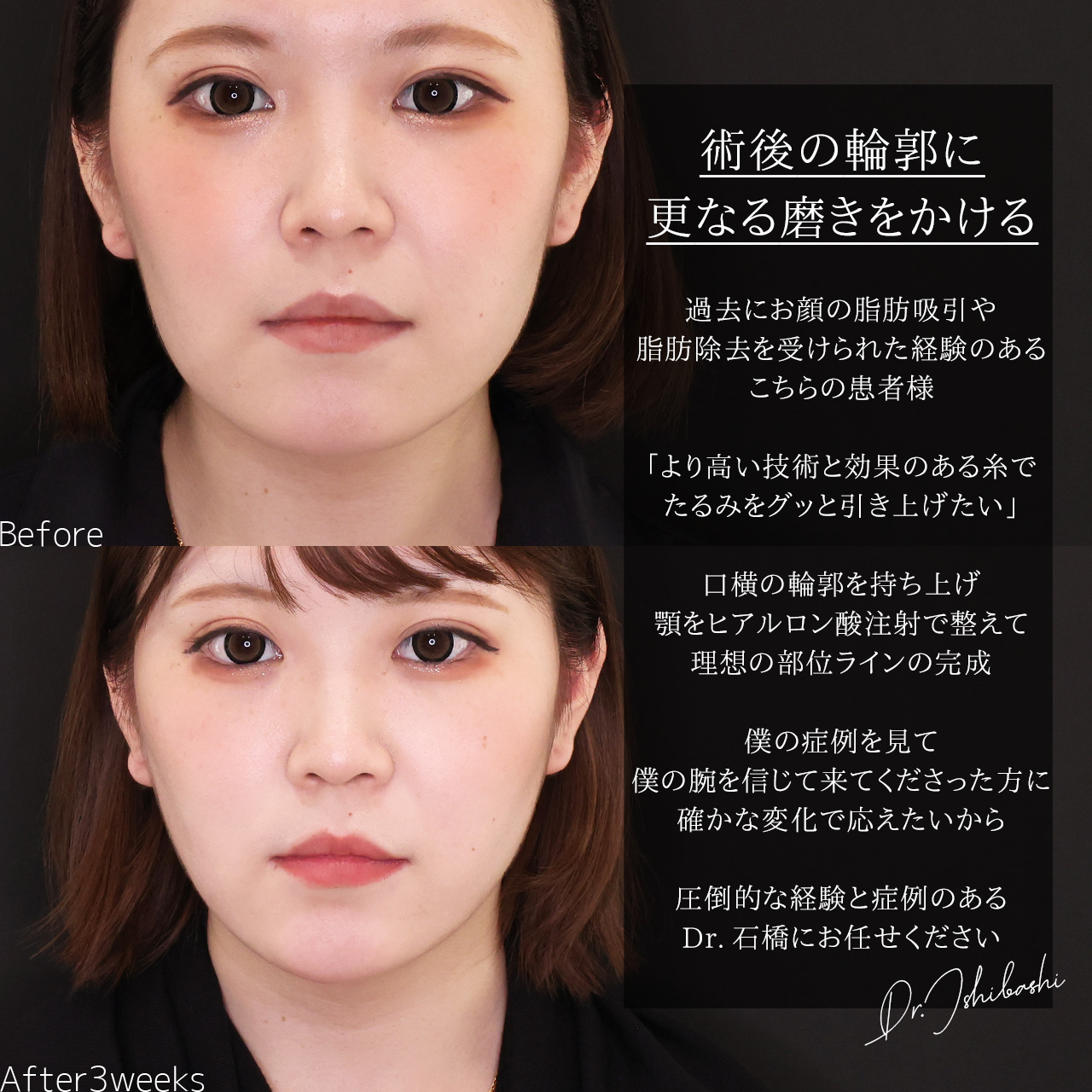 TAC式 ツヤ肌コラーゲンリフト®/顎のヒアルロン酸注射の症例写真 施術前後 