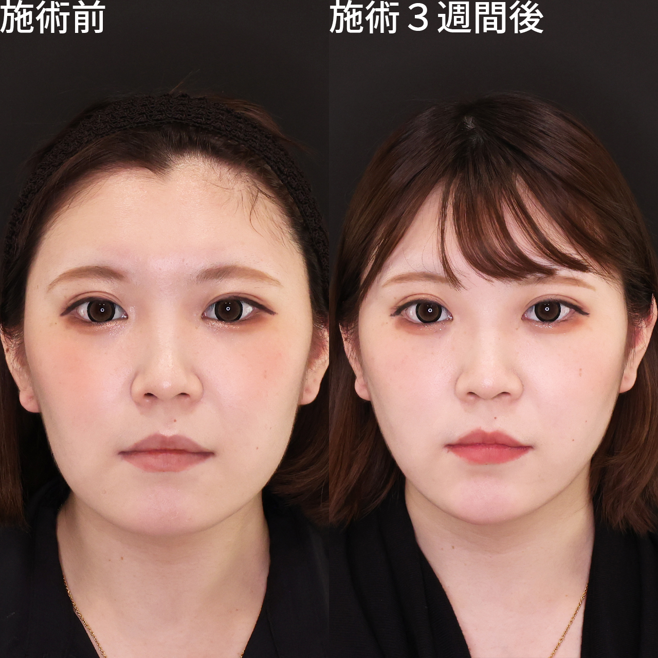 当日施術でその日から輪郭変わる！【ツヤ肌コラーゲンリフト】