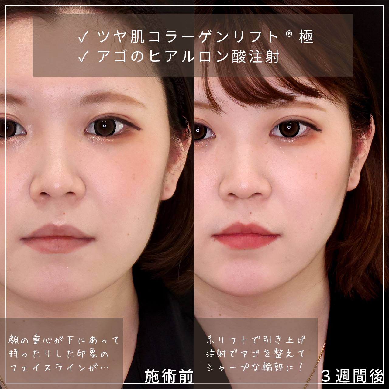 TAC式 ツヤ肌コラーゲンリフト®/顎のヒアルロン酸注射の症例写真 施術前後 
