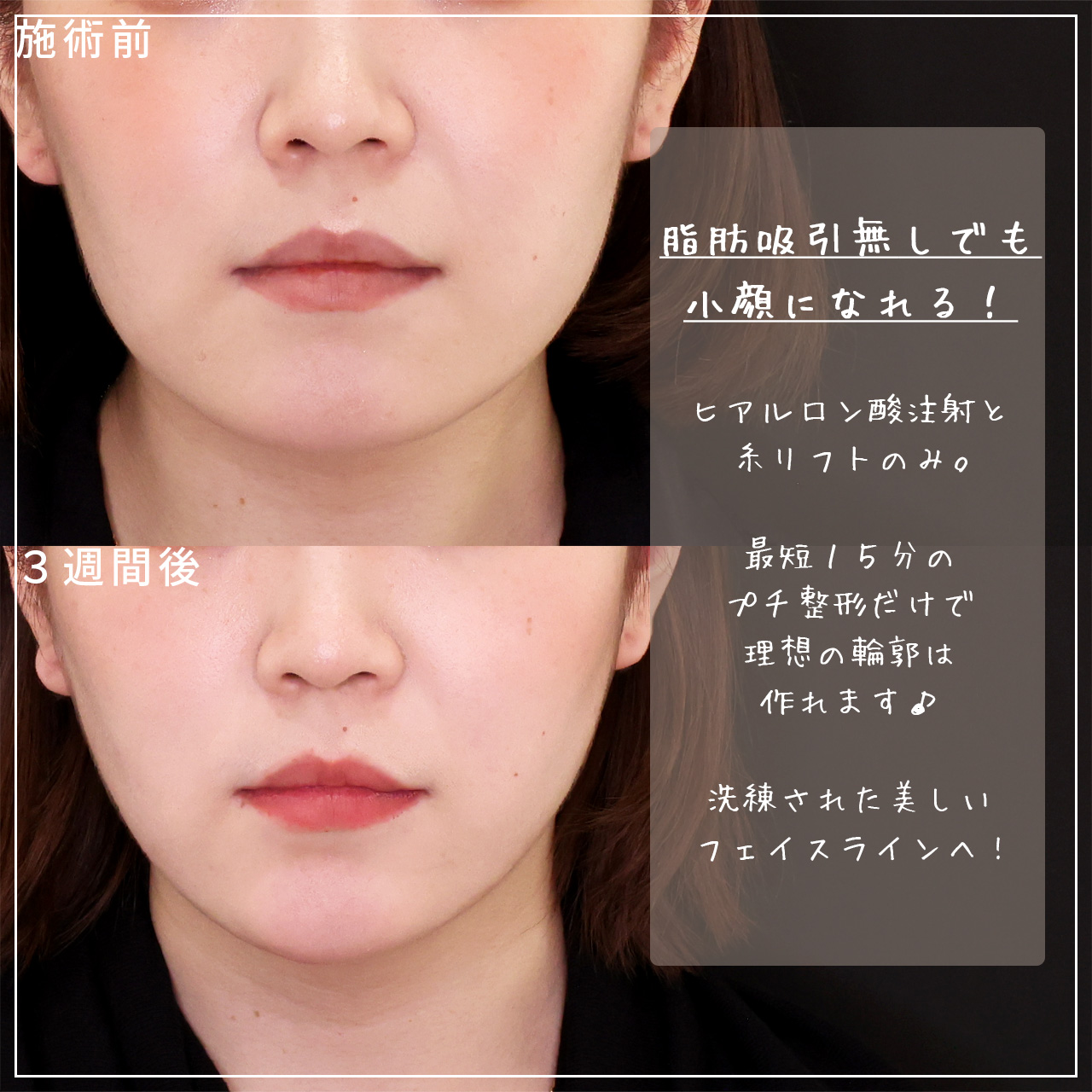 TAC式 ツヤ肌コラーゲンリフト®/顎のヒアルロン酸注射の症例写真 施術前後 