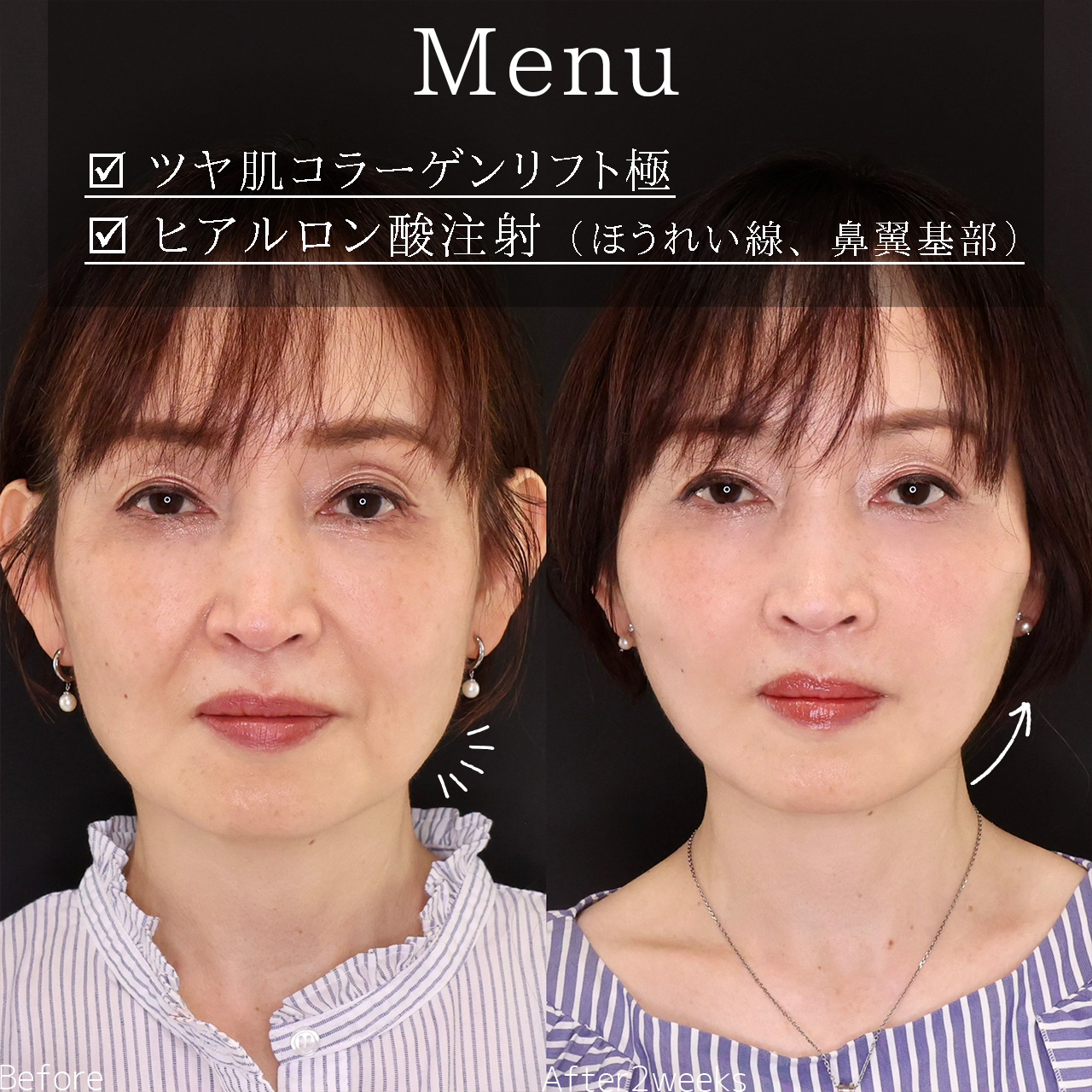 TAC式 ツヤ肌コラーゲンリフト®/ほうれい線のヒアルロン酸注射の症例写真 施術前後