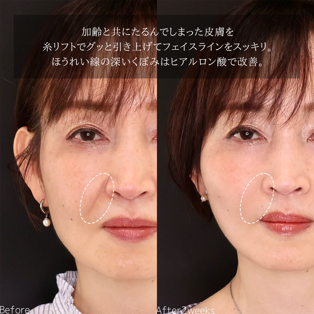 TAC式 ツヤ肌コラーゲンリフト®/ほうれい線のヒアルロン酸注射の症例写真 施術前後