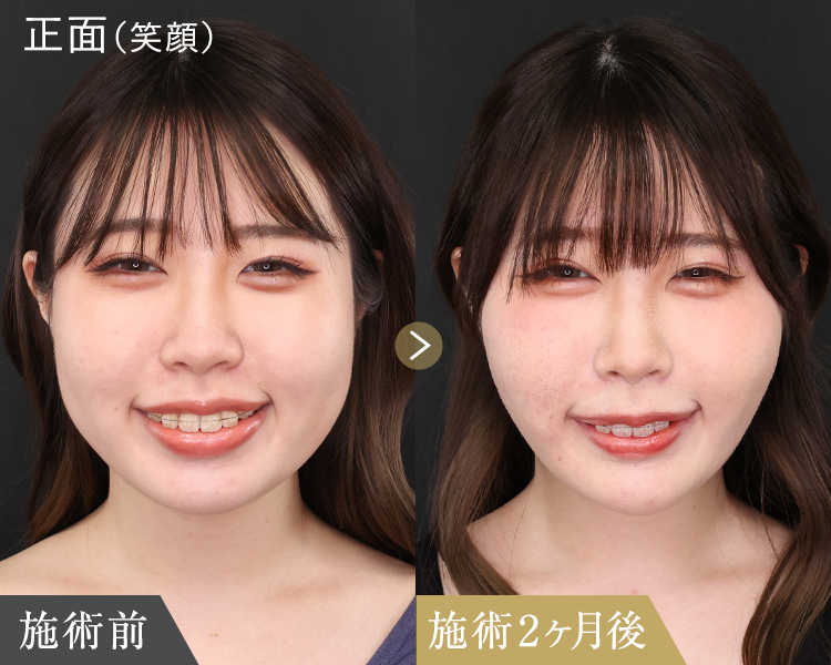 糸リフトと顔の脂肪吸引・除去｜笑顔の2カ月後の症例画像
