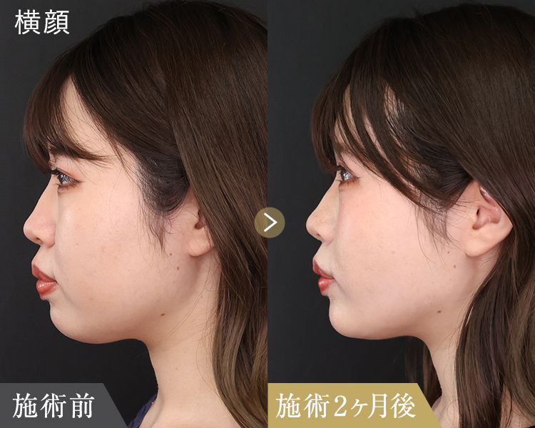 糸リフトと顔の脂肪吸引・除去｜横顔の2カ月後の症例画像