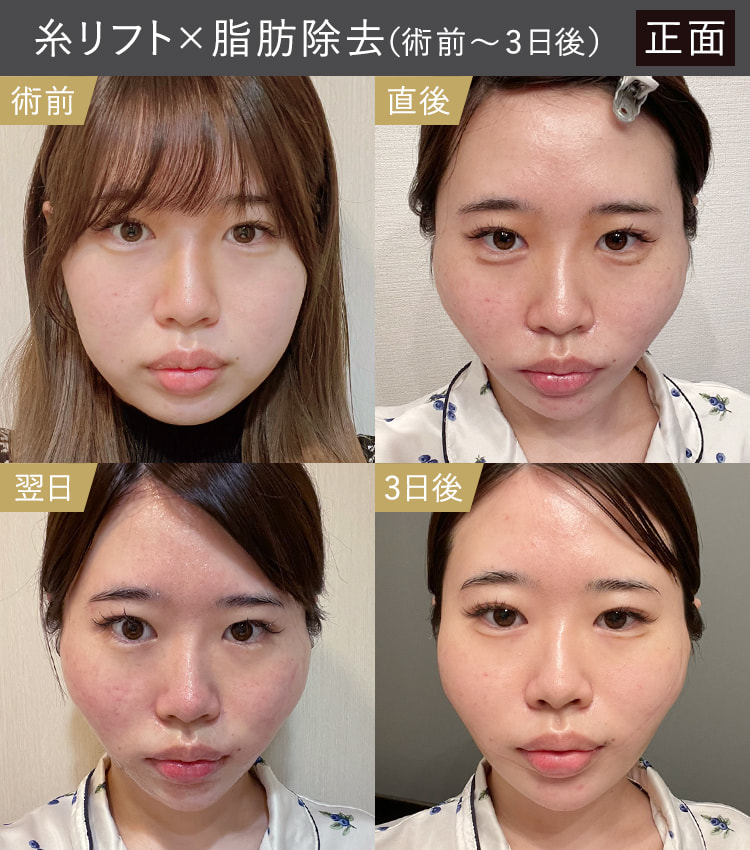 糸リフトと顔の脂肪吸引・除去|術前・直後・翌日・3日後の正面のダウンタイム症例画像
