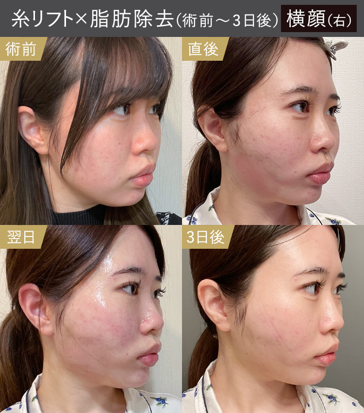 糸リフトと顔の脂肪吸引・除去|術前・直後・翌日・3日後の右横顔のダウンタイム症例画像