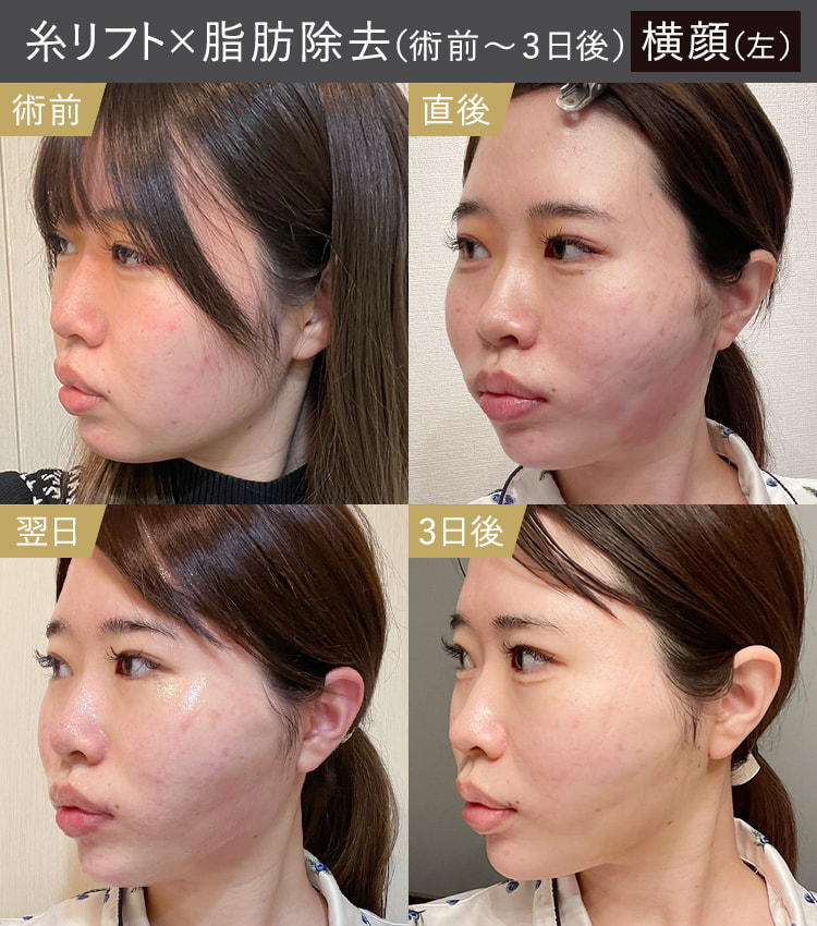 糸リフトと顔の脂肪吸引・除去|術前・直後・翌日・3日後の左横顔のダウンタイム症例画像