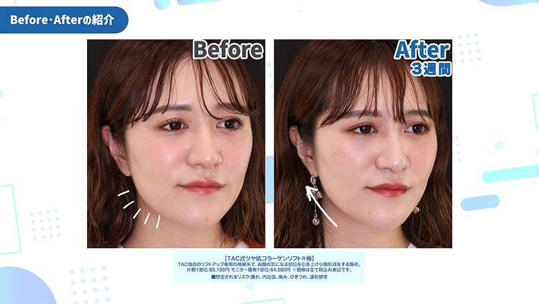 ツヤ肌コラーゲンリフト極の術前と術後3週間の比較症例写真