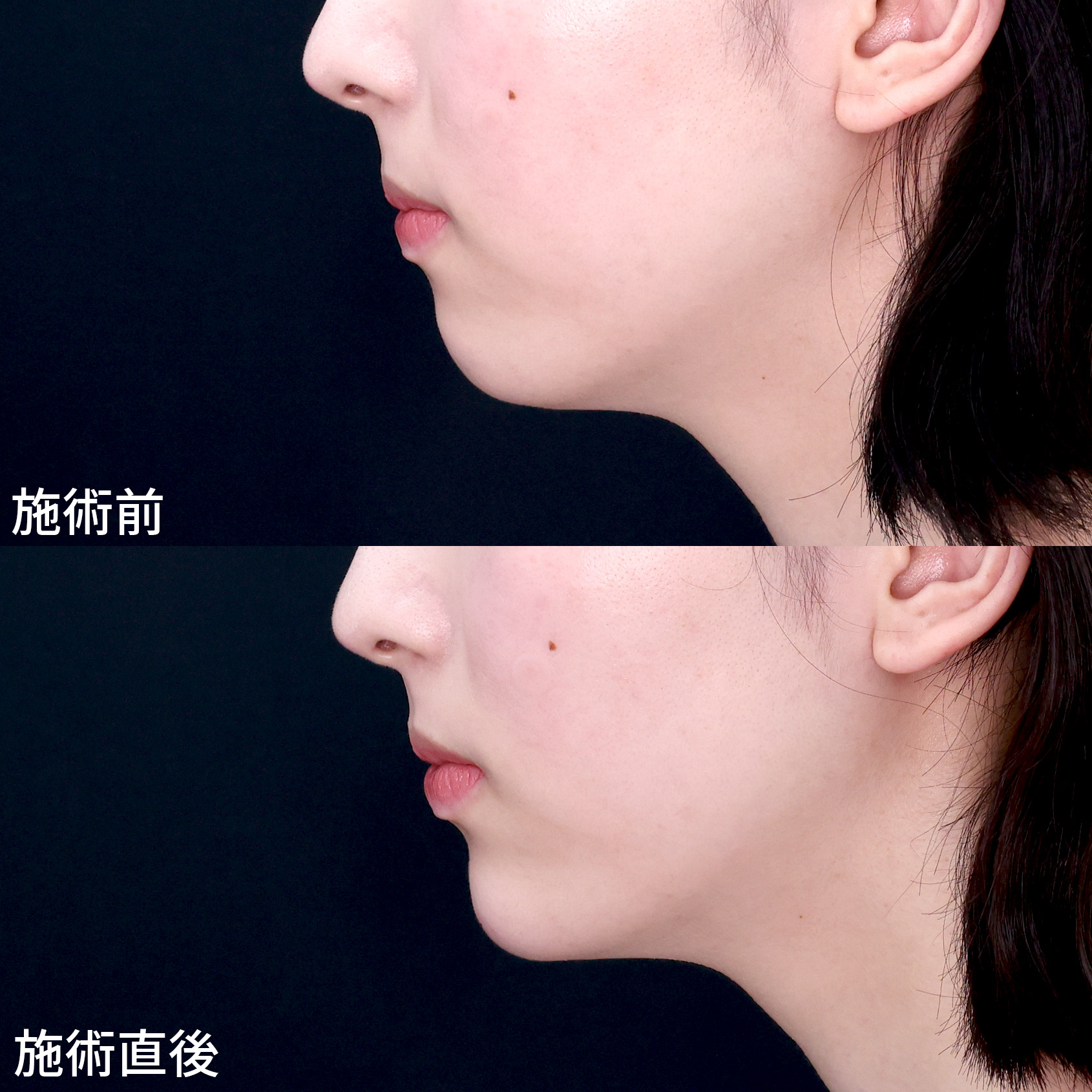 注射のみで盛れる輪郭へ！【ヒアルロン酸】