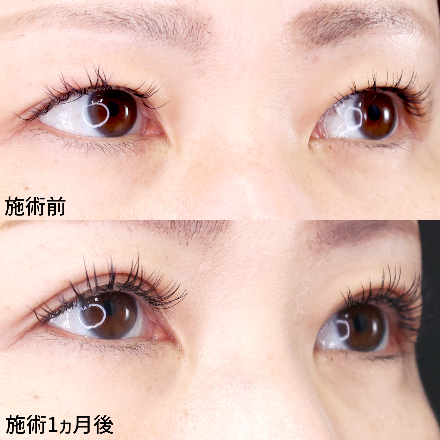 瞼のたるみを解消！くっきり二重に！【埋没法】