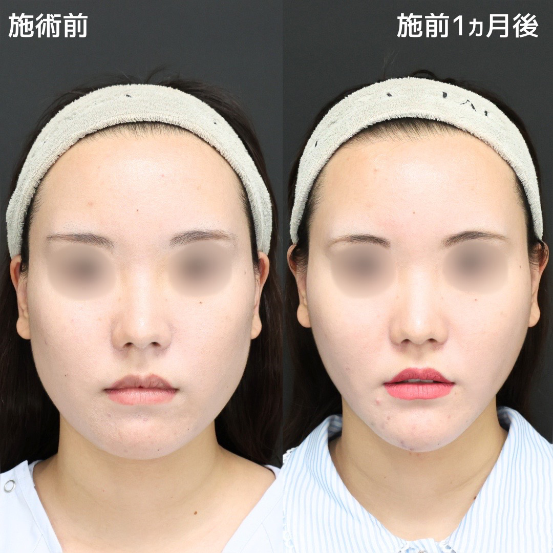 【小顔整形】まるで女優級の変化率
