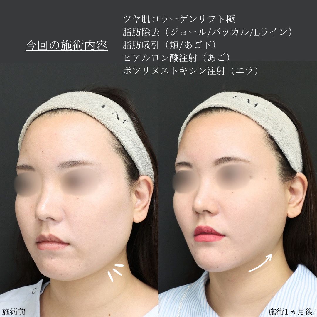 TAC式 ツヤ肌コラーゲンリフト®/ジョールファット除去/Lラインファット除去（エラ下脂肪除去）の症例写真 施術前後 