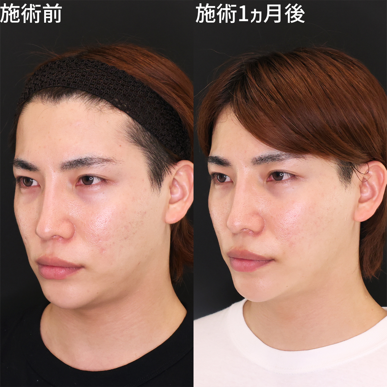 ジョールファット除去/TAC式 ツヤ肌コラーゲンリフト®/エラボトックス注射の症例写真 施術前後 