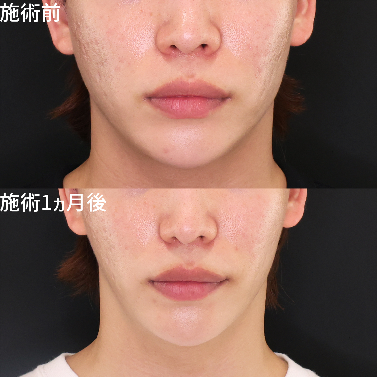 ジョールファット除去/TAC式 ツヤ肌コラーゲンリフト®/エラボトックス注射の症例写真 施術前後 