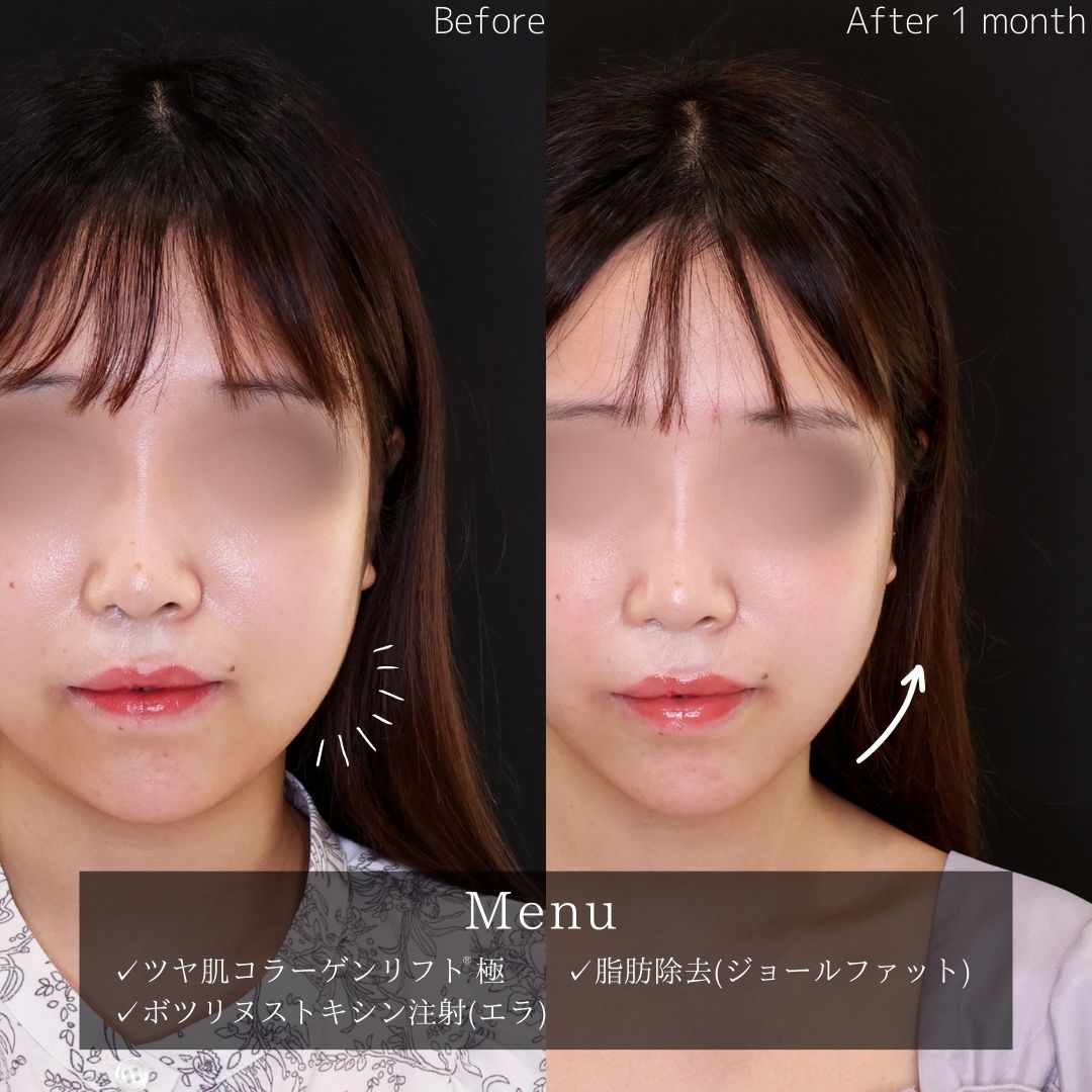 TAC式 ツヤ肌コラーゲンリフト®/ジョールファット除去/エラボトックス注射の症例写真 施術前後 