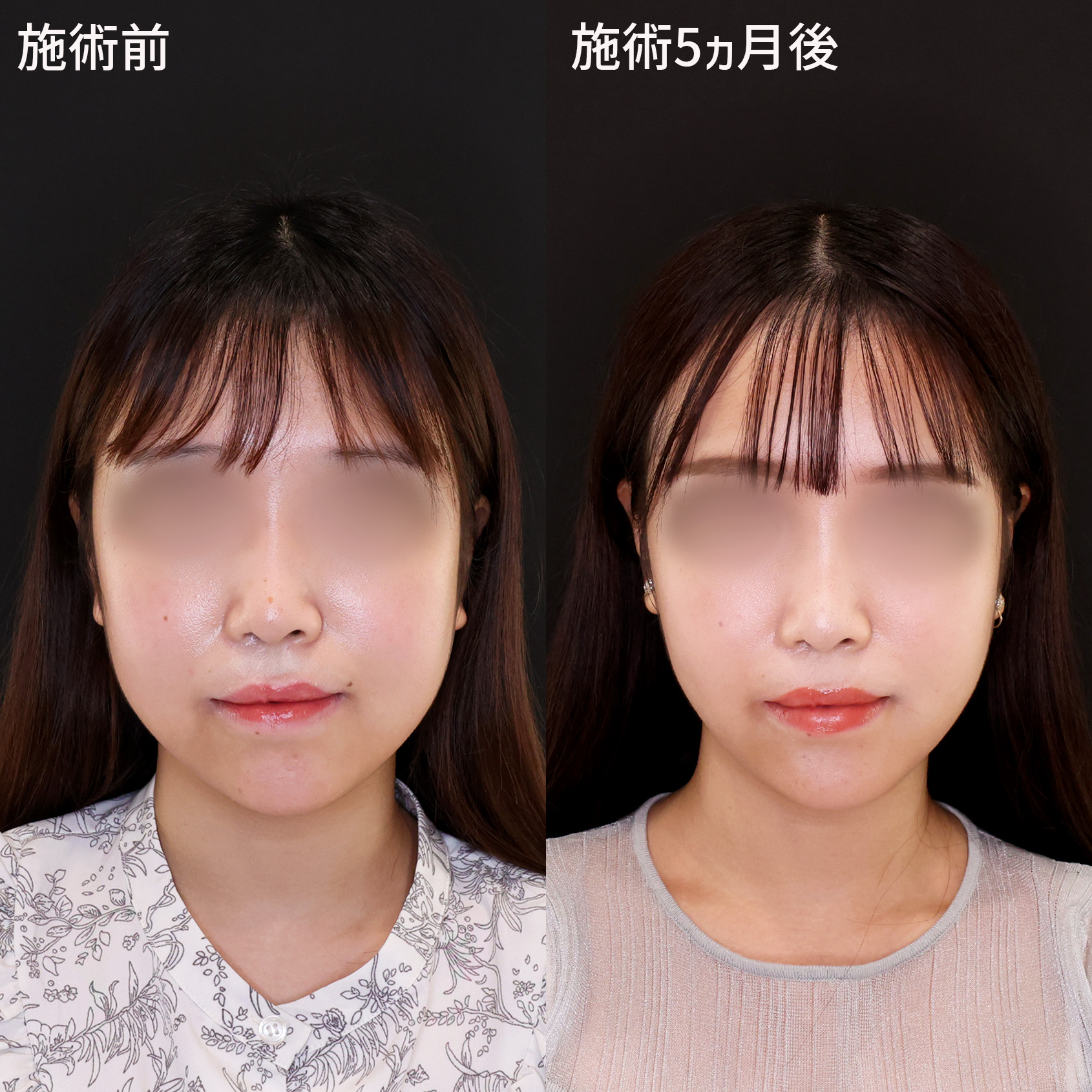 TAC式 ツヤ肌コラーゲンリフト®/ジョールファット除去/エラボトックス注射の症例写真 施術前後 